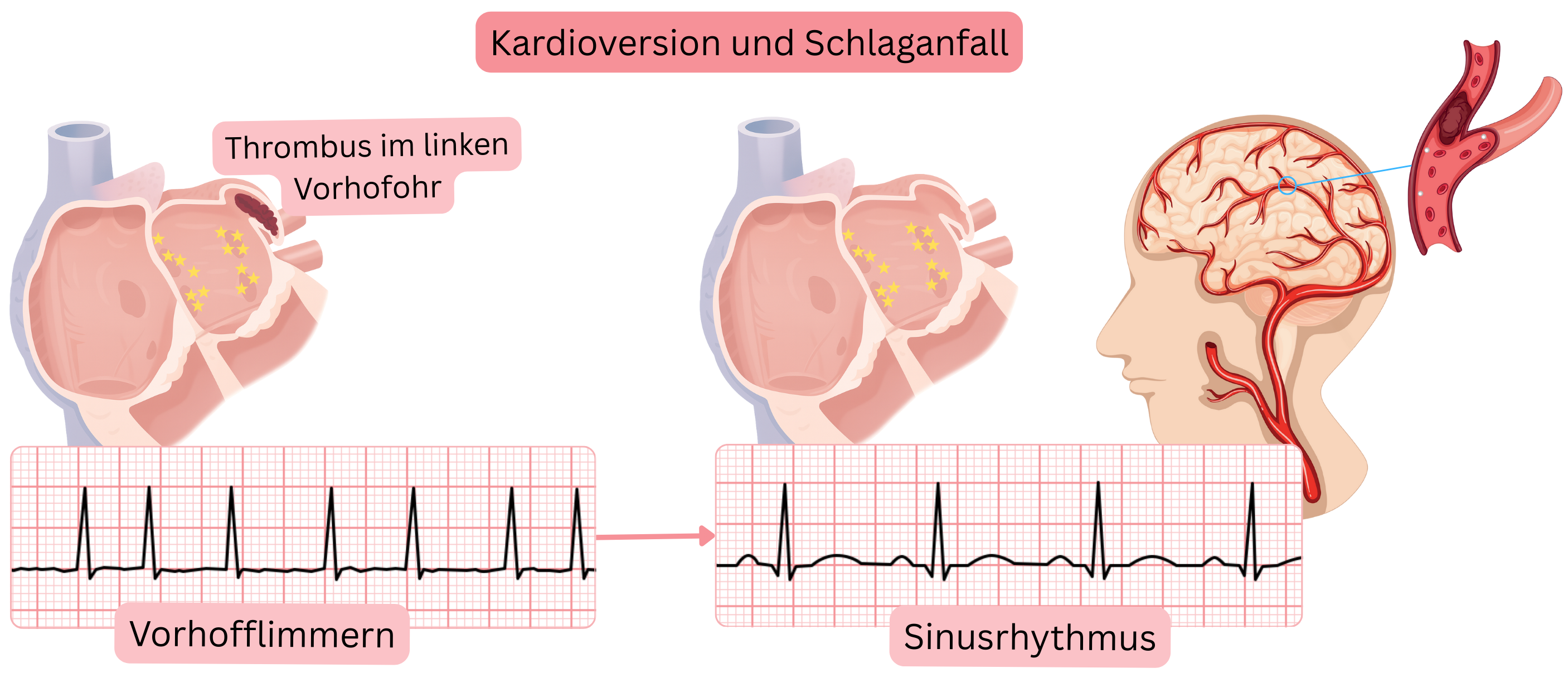 Schema zur Darstellung des Schlaganfallrisikos nach Kardioversion von Vorhofflimmern infolge der Embolisation eines Thrombus aus dem linken Vorhofohr bei Wiederherstellung des Sinusrhythmus.