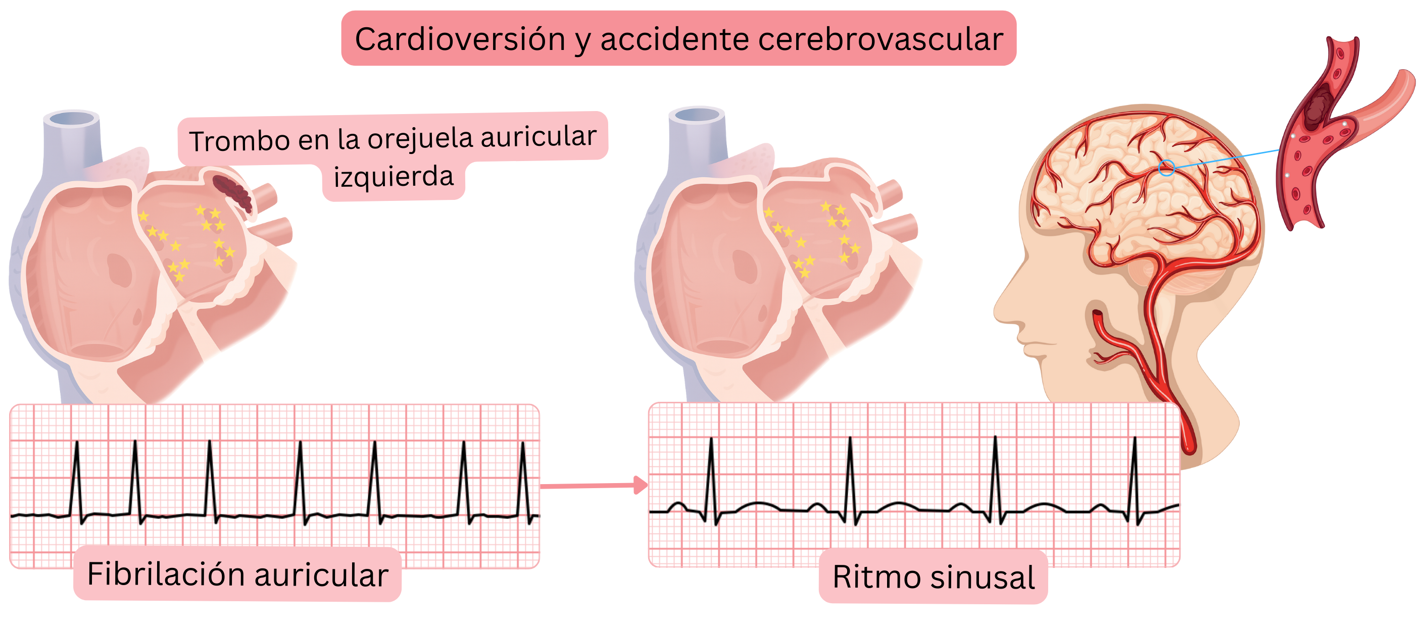 Esquema que muestra el riesgo de accidente cerebrovascular tras la cardioversión de la fibrilación auricular debido a la embolización de un trombo desde la orejuela auricular izquierda al restaurarse el ritmo sinusal.