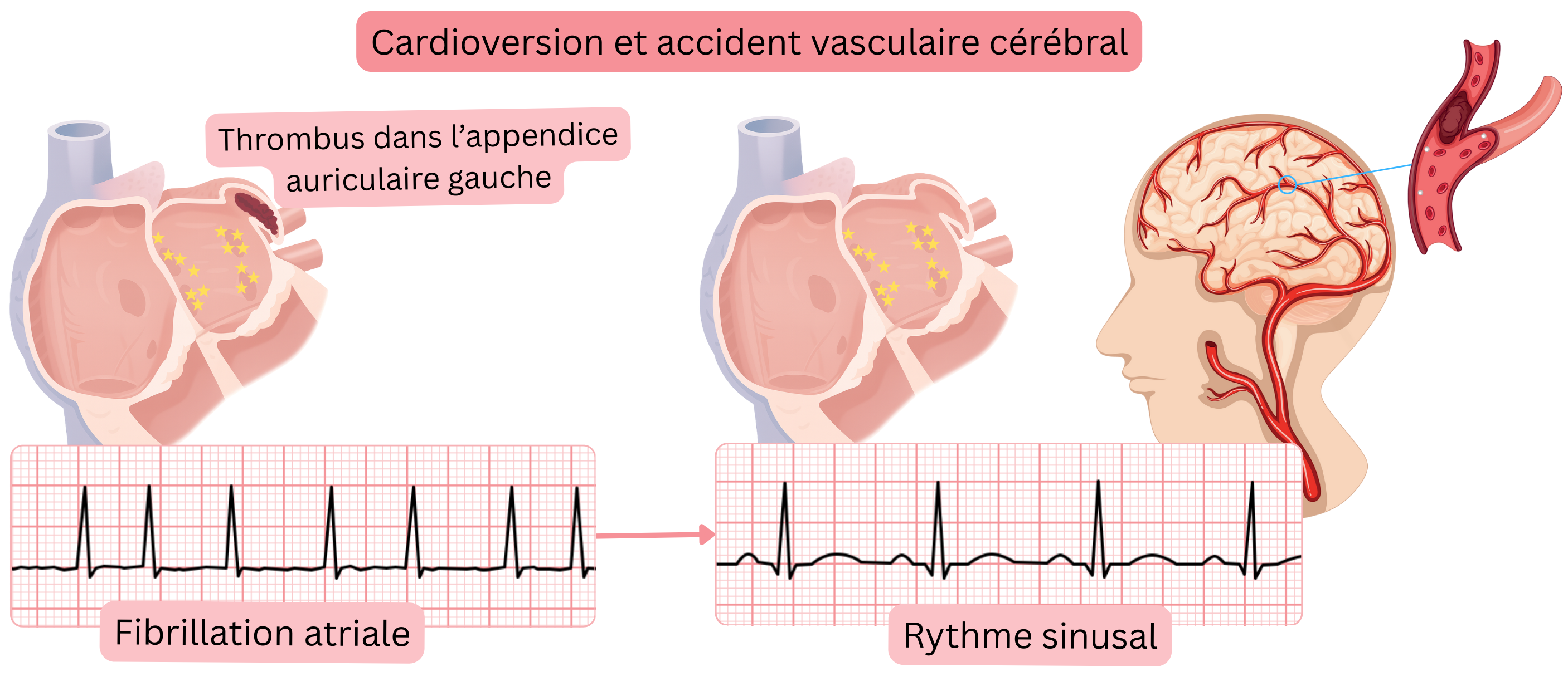 Schéma illustrant le risque d’accident vasculaire cérébral après la cardioversion de la fibrillation auriculaire en raison de l’embolisation d’un thrombus issu de l’appendice auriculaire gauche lors du rétablissement du rythme sinusal.