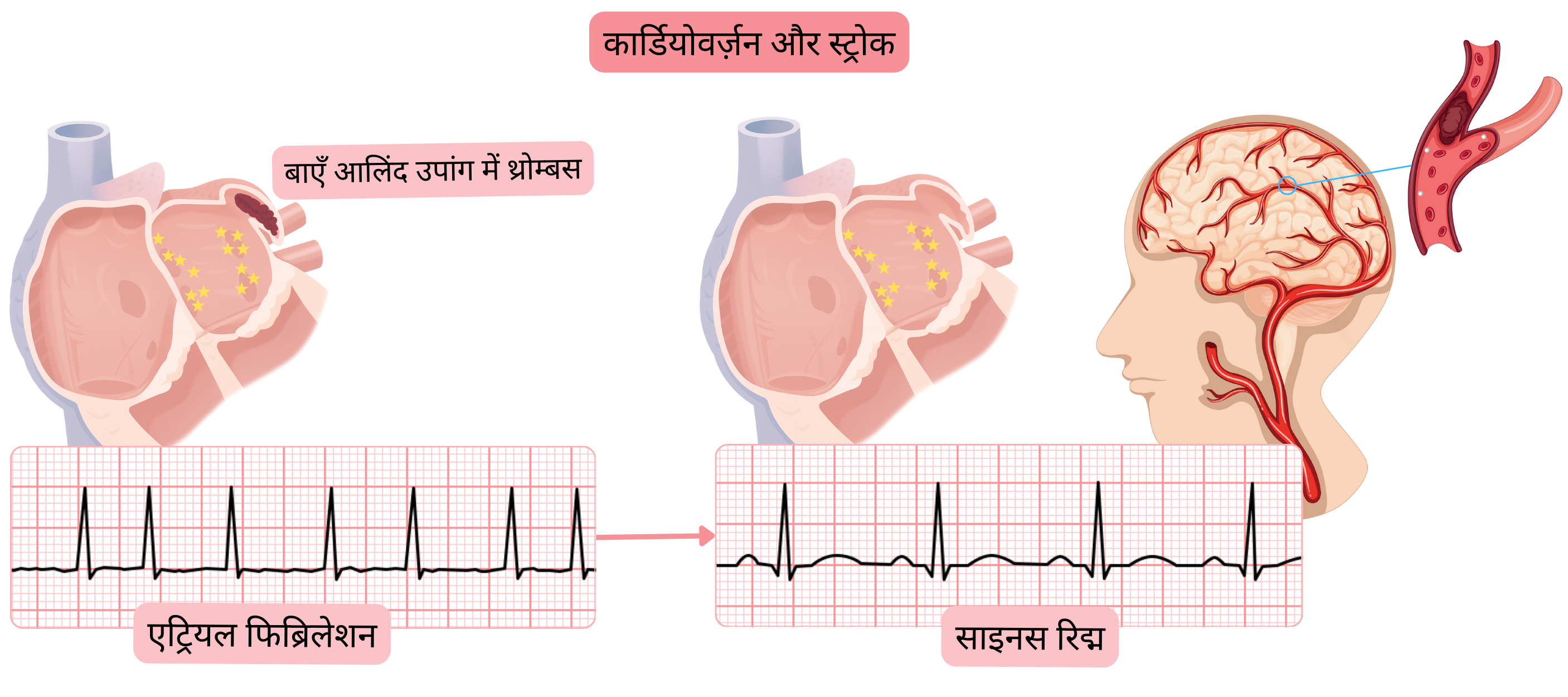 एट्रियल फिब्रिलेशन की कार्डियोवर्ज़न के बाद स्ट्रोक के जोखिम का आरेख, जिसमें साइनस रिद्म की पुनःस्थापना पर लेफ्ट एट्रियल एपेंडेज से थ्रोम्बस के एम्बोलाइज़ेशन को दर्शाया गया है।