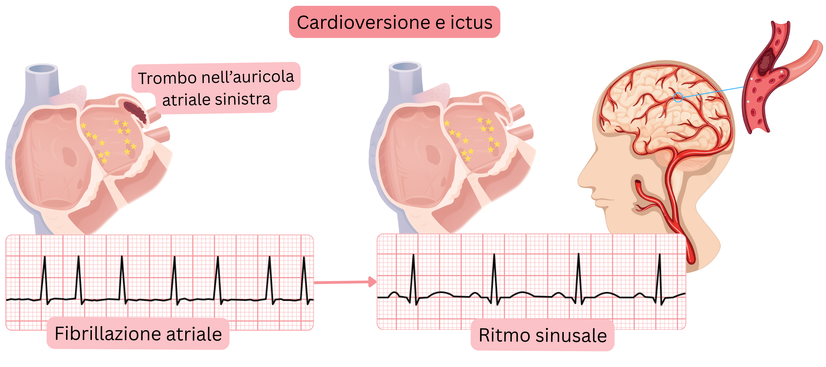 Schema che illustra il rischio di ictus dopo la cardioversione della fibrillazione atriale dovuto all’embolizzazione di un trombo dall’auricola atriale sinistra con il ripristino del ritmo sinusale.