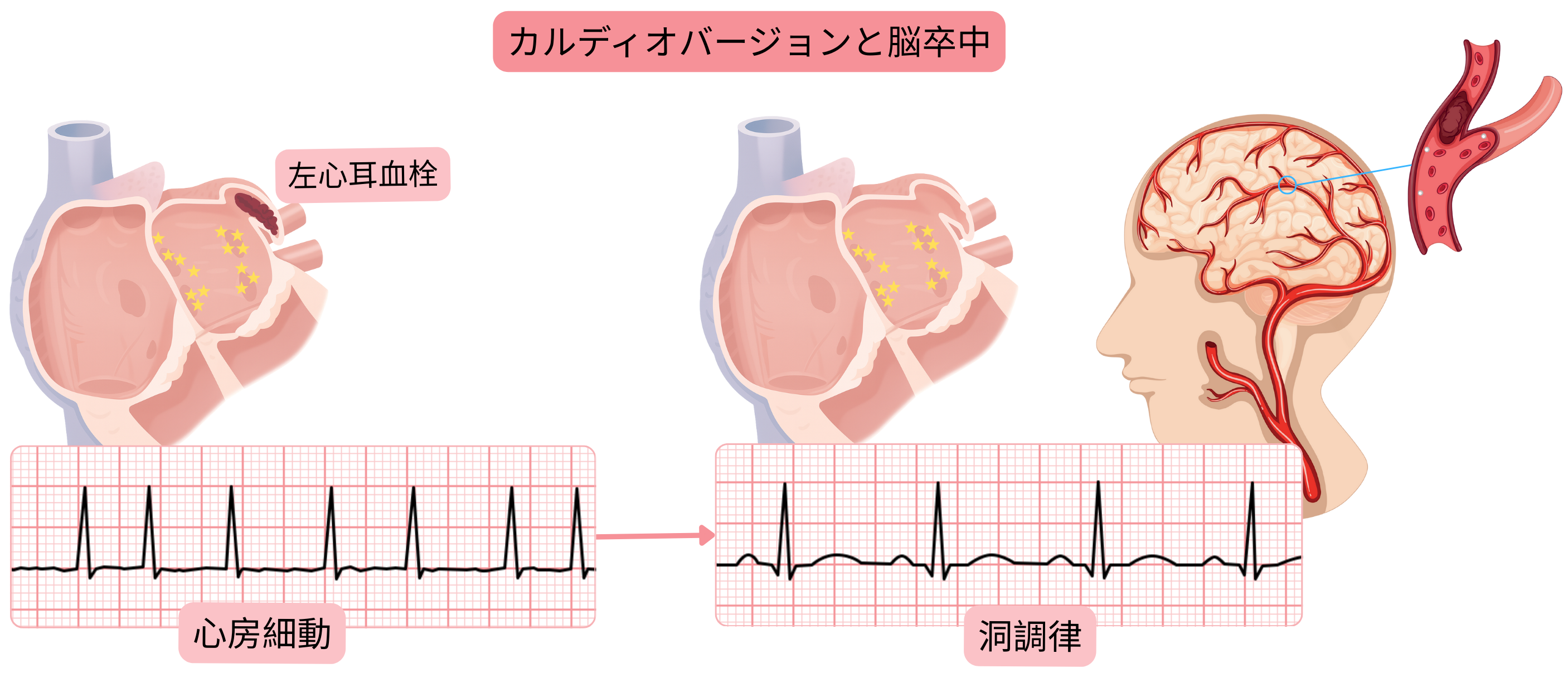 洞調律回復時に左心耳内血栓が塞栓化することによる、心房細動カルディオバージョン後の脳卒中リスクを示す模式図。