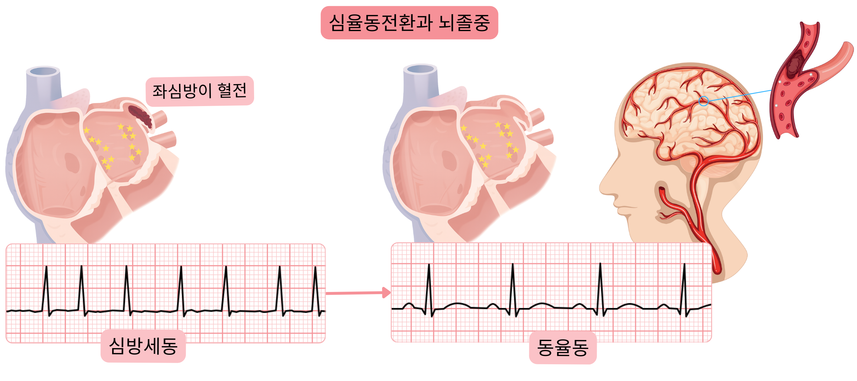 동율동 회복 시 좌심방이에서 혈전이 색전되어 심방세동 심율동전환 후 뇌졸중 위험이 증가함을 나타낸 도식.
