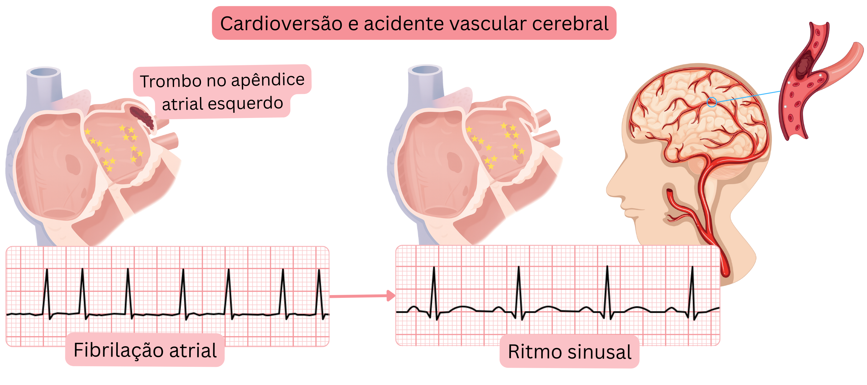 Esquema demonstrando o risco de acidente vascular cerebral após a cardioversão da fibrilação atrial devido à embolização de um trombo do apêndice atrial esquerdo com o restabelecimento do ritmo sinusal.
