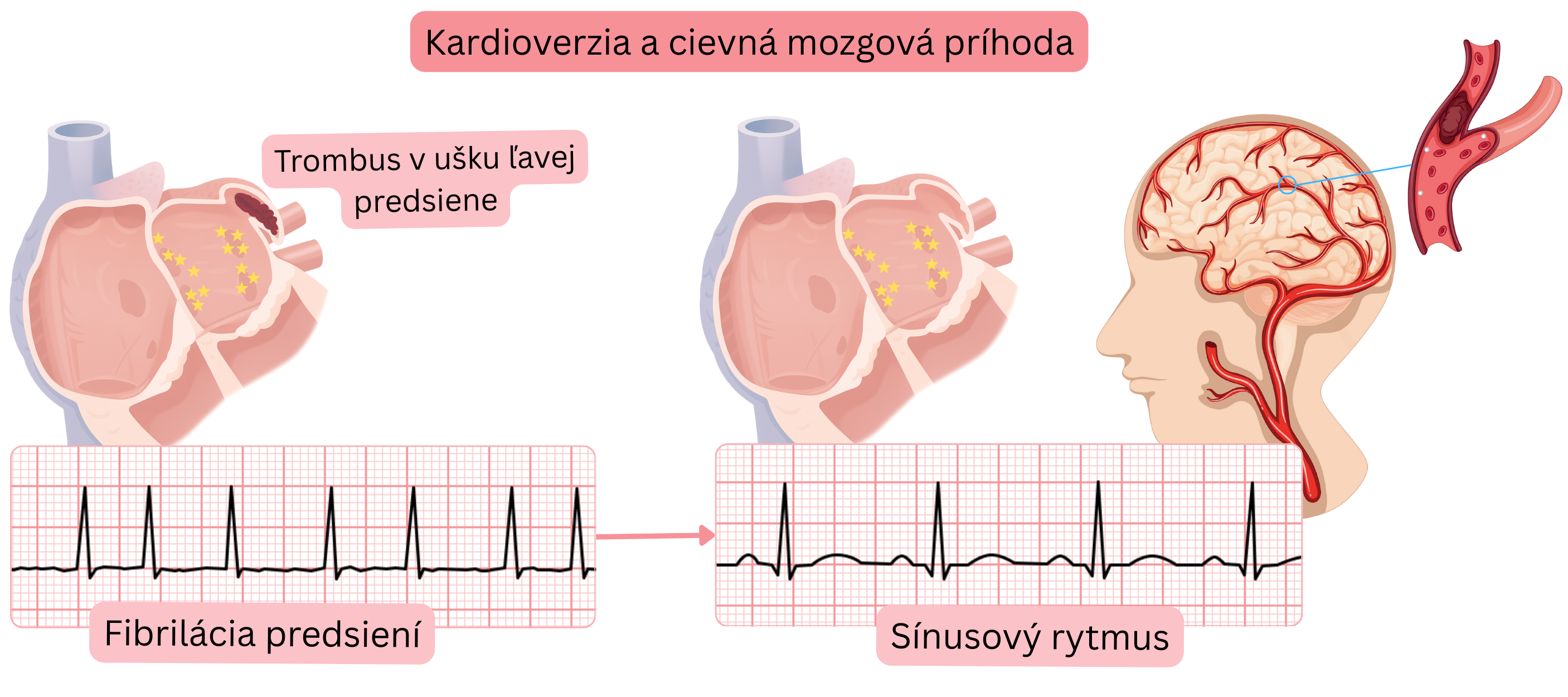 Schéma znázorňujúca riziko cievnej mozgovej príhody po kardioverzii fibrilácie predsiení v dôsledku embolizácie trombu z uška ľavej predsiene pri obnovení sínusového rytmu.