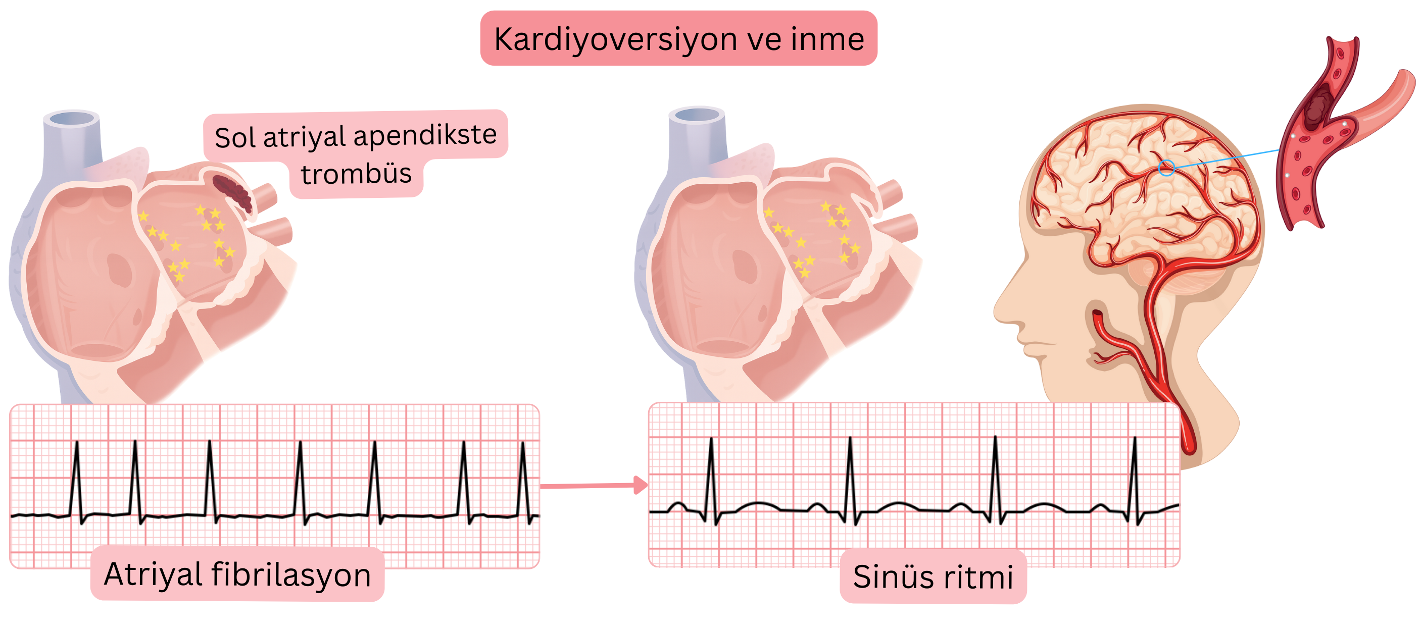Atriyal fibrilasyon kardiyoversiyonu sonrasında sinüs ritminin yeniden sağlanmasıyla sol atriyal apendiksten trombüs embolizasyonuna bağlı inme riskini gösteren şema.