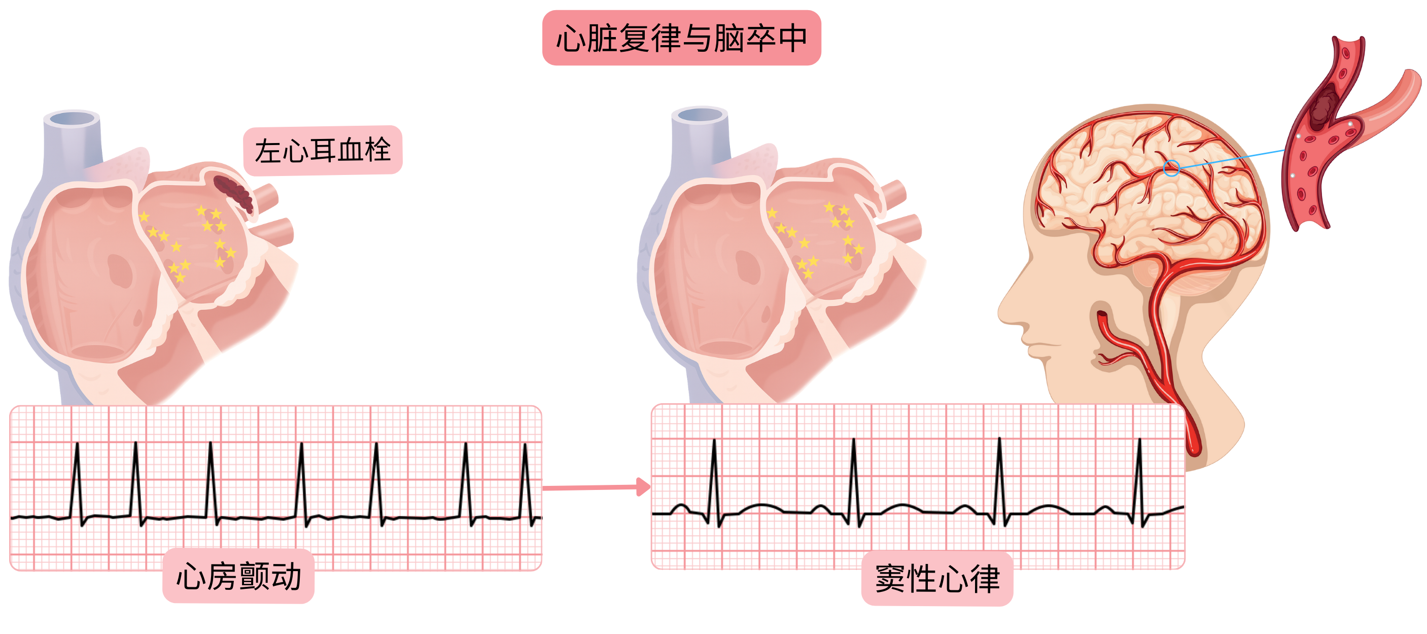 示意图显示心房颤动复律后因左心耳血栓栓塞而增加脑卒中风险，发生于窦性心律恢复时。
