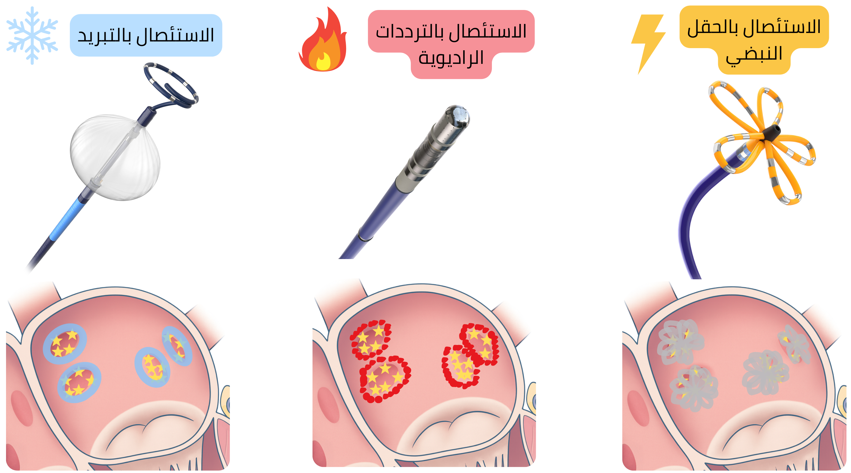 مخطط يقارن بين تقنيات الاستئصال بالقسطرة لعلاج الرجفان الأذيني، بما في ذلك الاستئصال بالتبريد، والاستئصال بالترددات الراديوية، والاستئصال بالمجال النبضي، مع اختلاف آليات إحداث الآفات في عضلة الأذين.