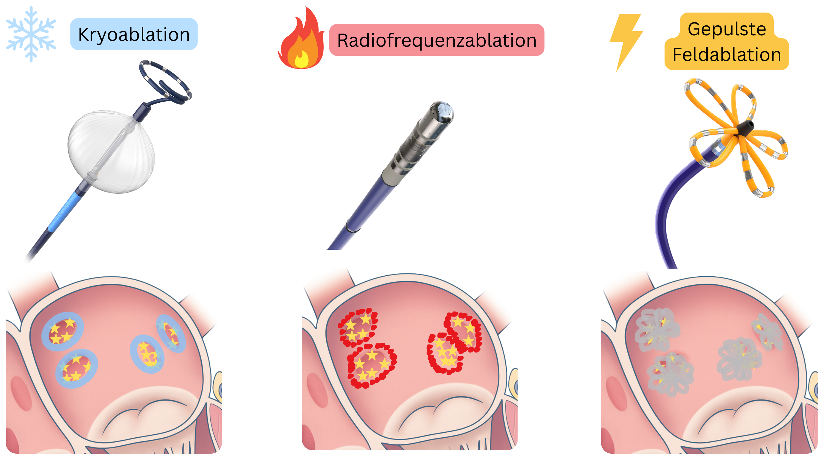Schema zum Vergleich der Katheterablationstechniken bei Vorhofflimmern, einschließlich Kryoablation, Radiofrequenzablation und Pulsfeldablation, mit unterschiedlichen Mechanismen der Läsionsbildung im Vorhofmyokard.