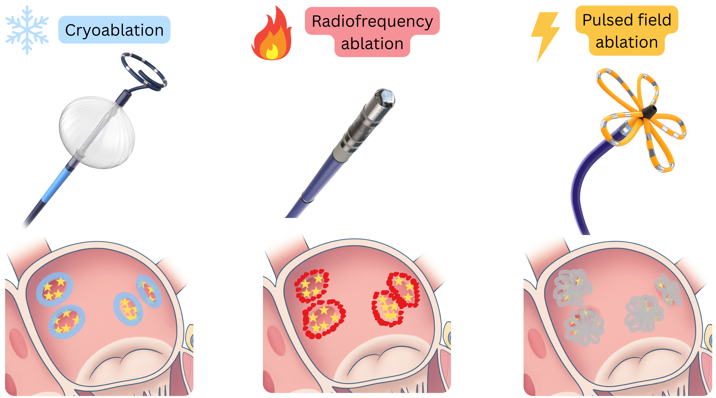 Diagram comparing catheter ablation techniques for atrial fibrillation, including cryoablation, radiofrequency ablation, and pulsed field ablation, highlighting different mechanisms of lesion formation in the atrial myocardium.