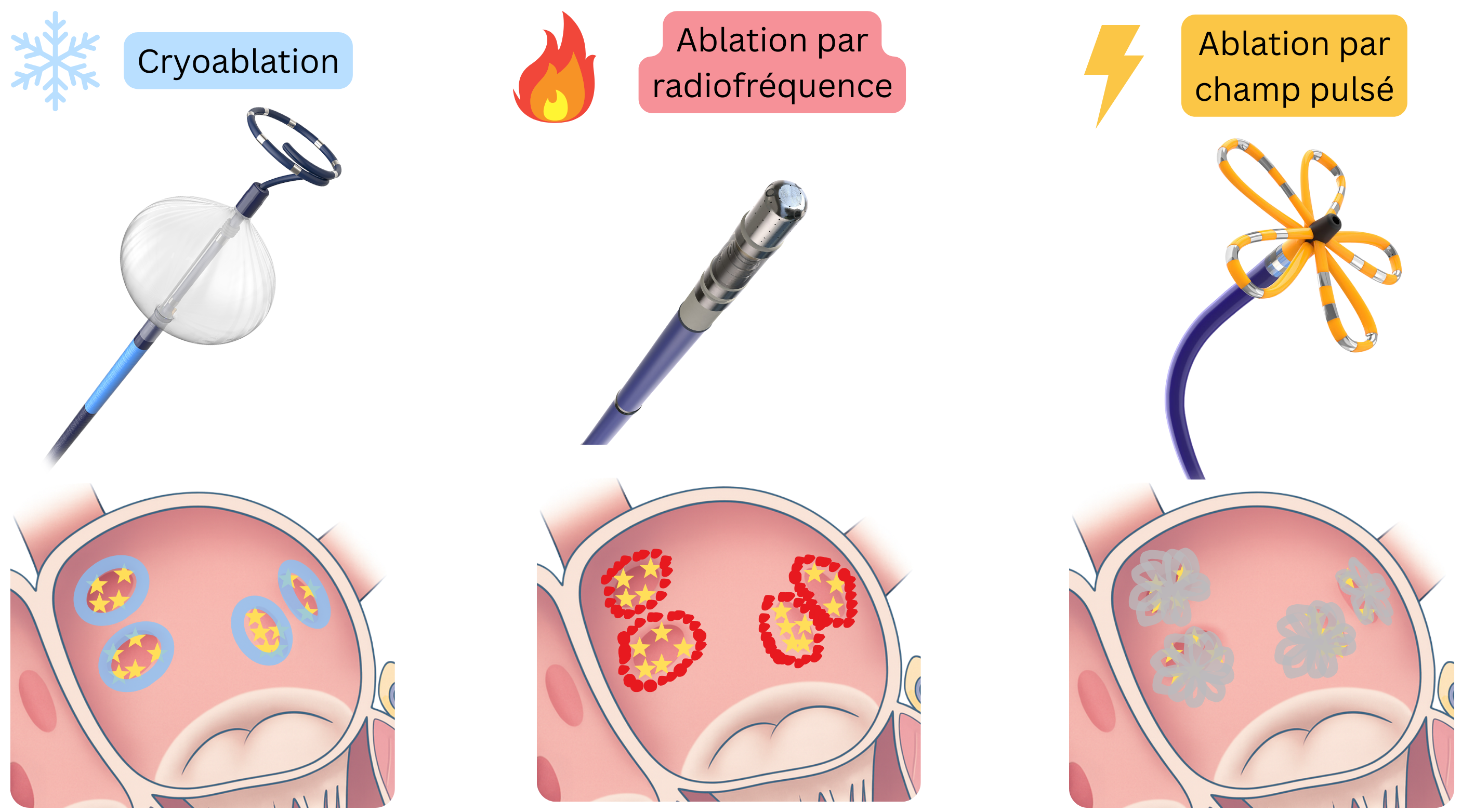 Schéma comparant les méthodes d’ablation par cathéter de la fibrillation auriculaire, incluant la cryoablation, l’ablation par radiofréquence et l’ablation par champ pulsé, avec des mécanismes différents de création des lésions du myocarde auriculaire.