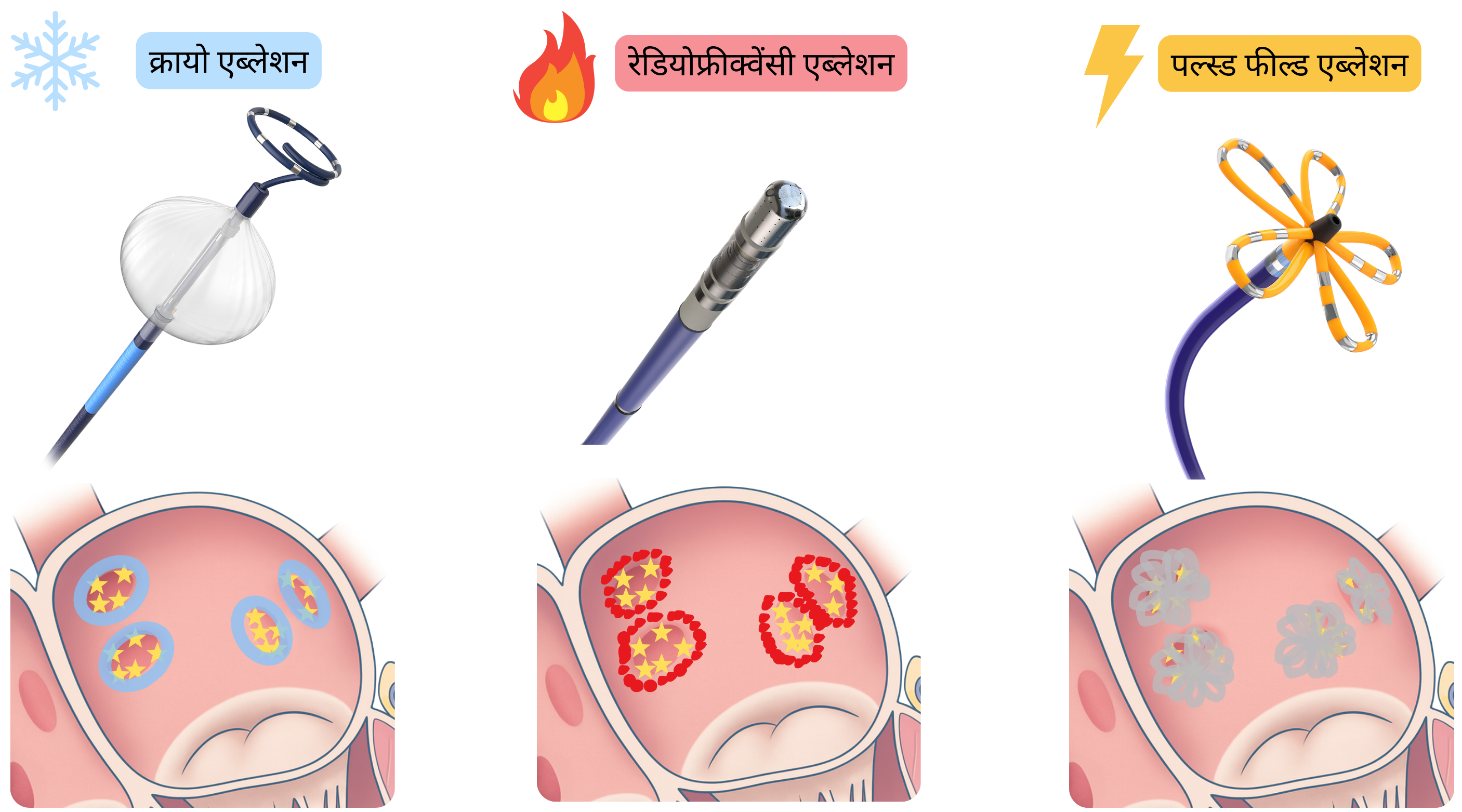 एट्रियल फिब्रिलेशन के लिए कैथेटर एब्लेशन तकनीकों की तुलना करने वाला आरेख, जिसमें क्रायोएब्लेशन, रेडियोफ्रीक्वेंसी एब्लेशन और पल्स्ड फील्ड एब्लेशन शामिल हैं तथा एट्रियल मायोकार्डियम में लेज़न बनने के विभिन्न तंत्र दर्शाए गए हैं।