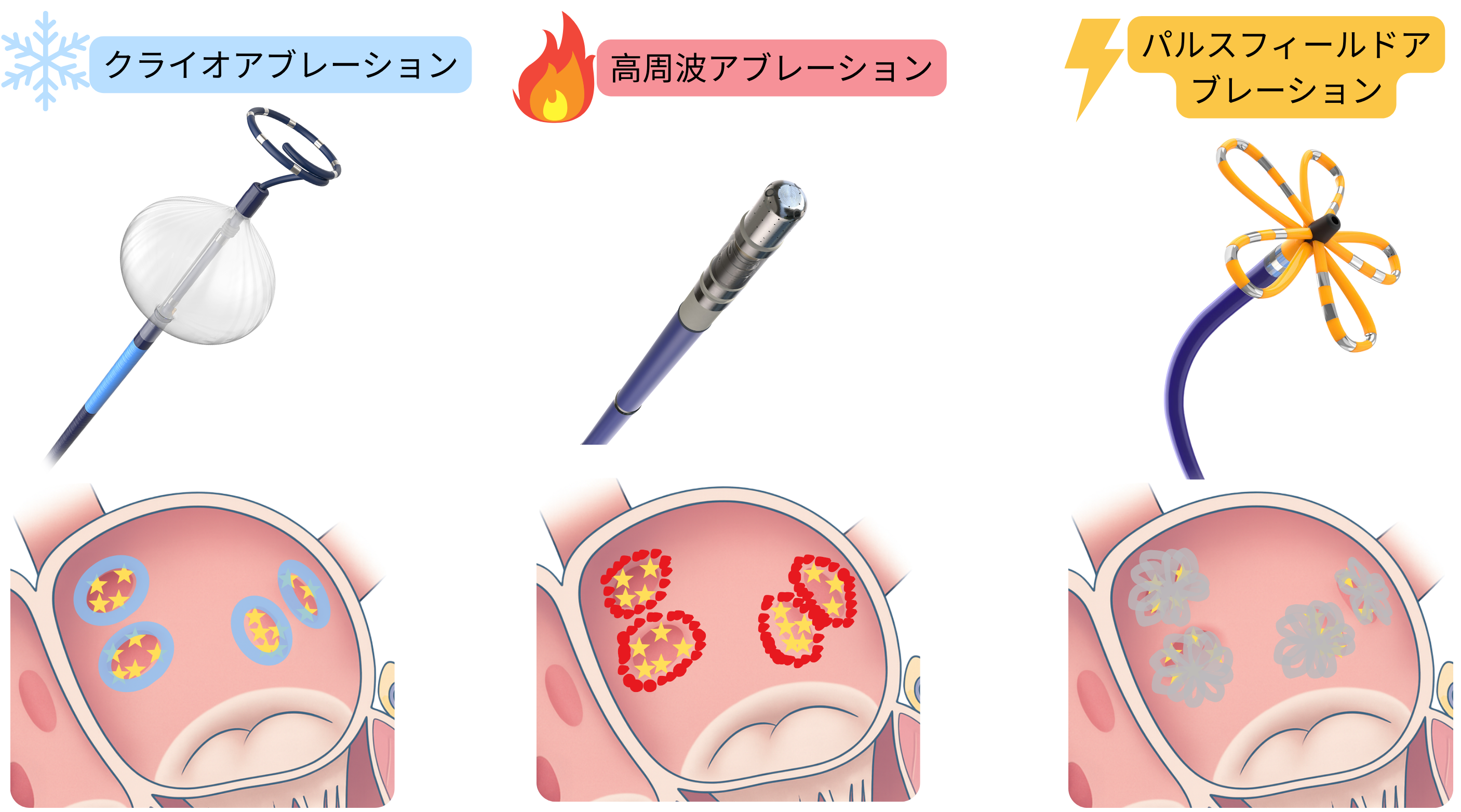 心房細動に対するカテーテルアブレーション法を比較した模式図で、クライオアブレーション、ラジオ波アブレーション、パルスフィールドアブレーションを含み、心房心筋における病変形成機序の違いを示す。