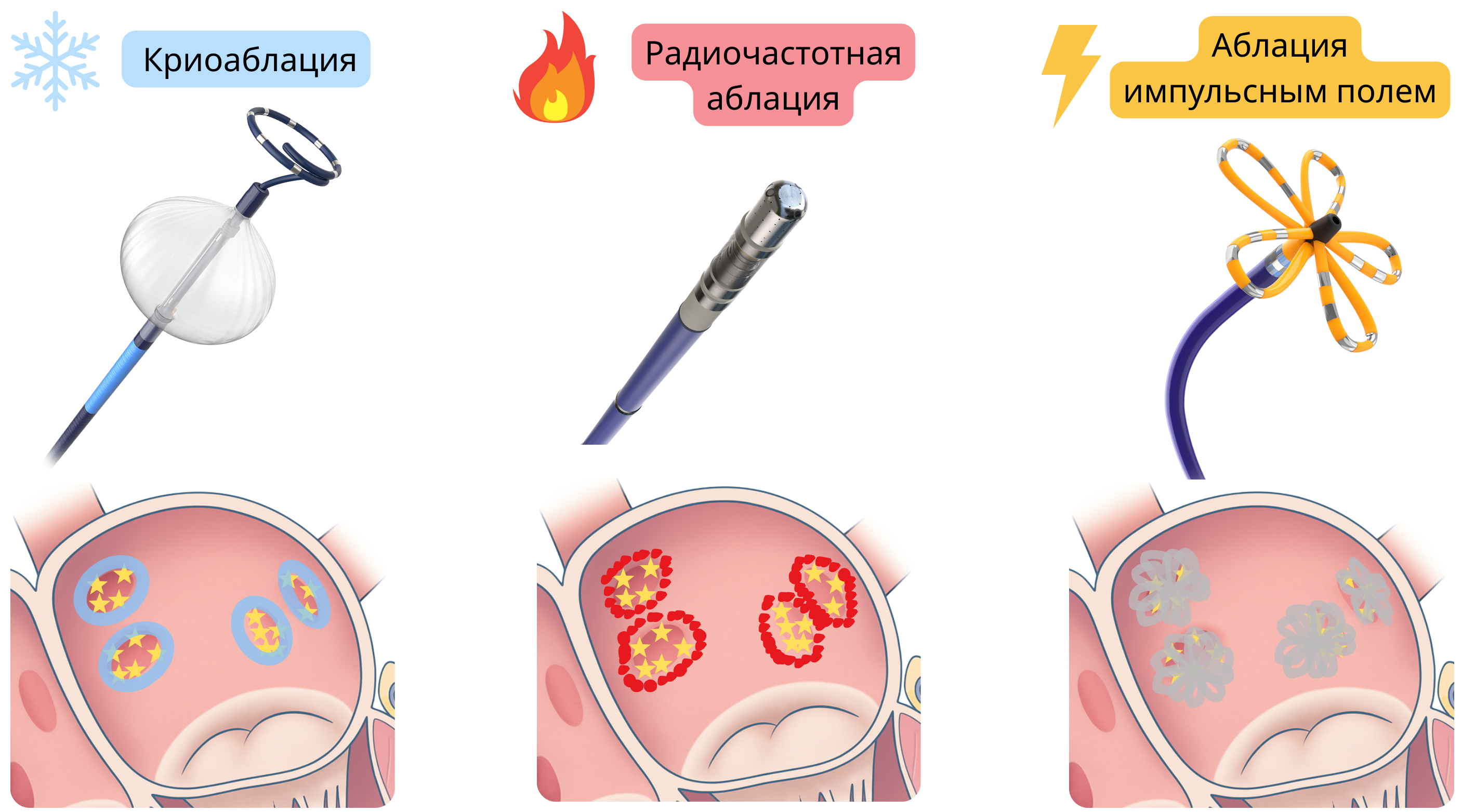 Схема сравнения методов катетерной аблации фибрилляции предсердий, включая криоаблацию, радиочастотную аблацию и аблацию импульсным полем, с различными механизмами формирования повреждений в миокарде предсердий.