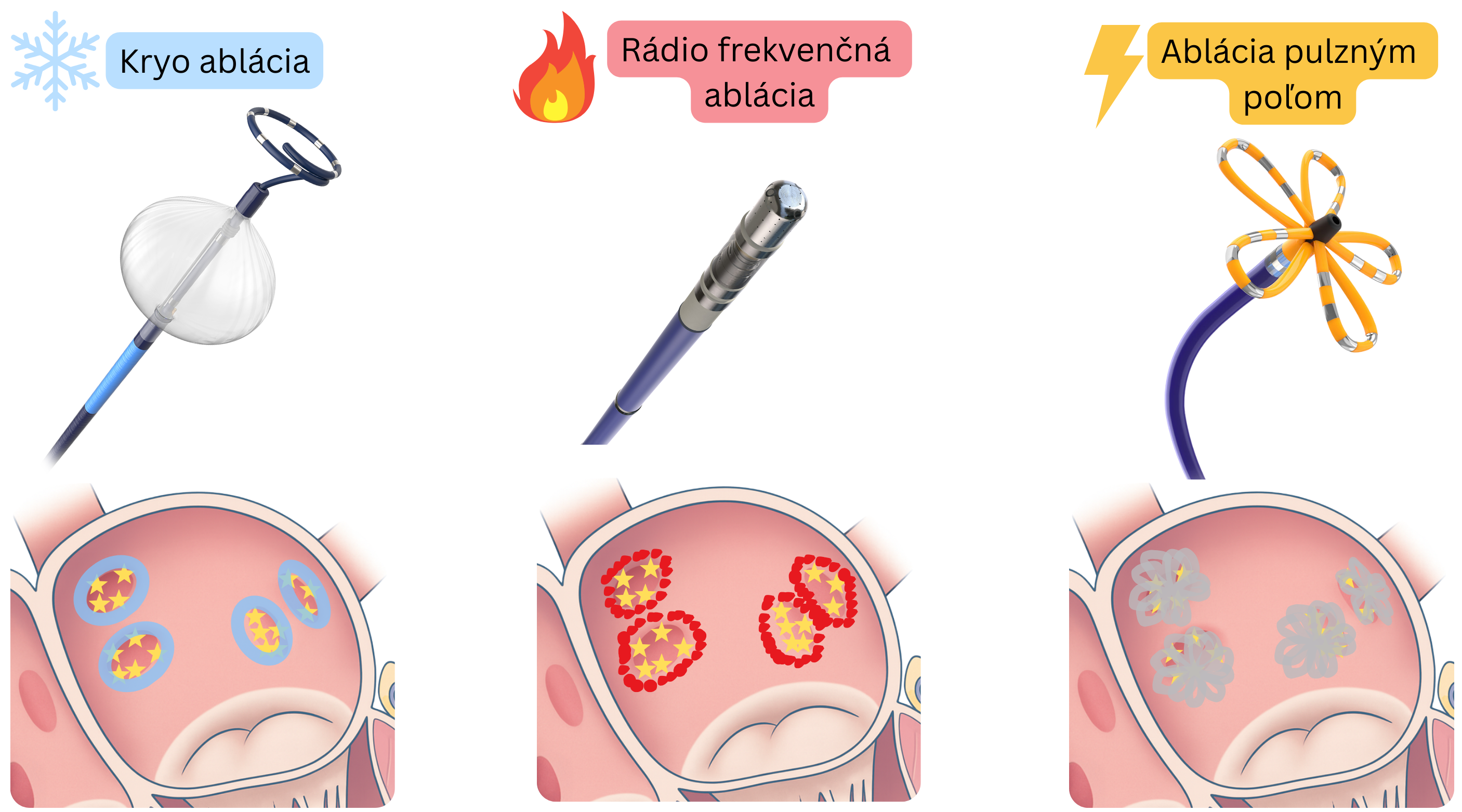 Schéma porovnávajúca metódy katétrovej ablácie fibrilácie predsiení vrátane kryoablácie, rádiofrekvenčnej ablácie a ablácie pulzným poľom s rozdielnym mechanizmom vytvárania lézií v myokarde predsiení.