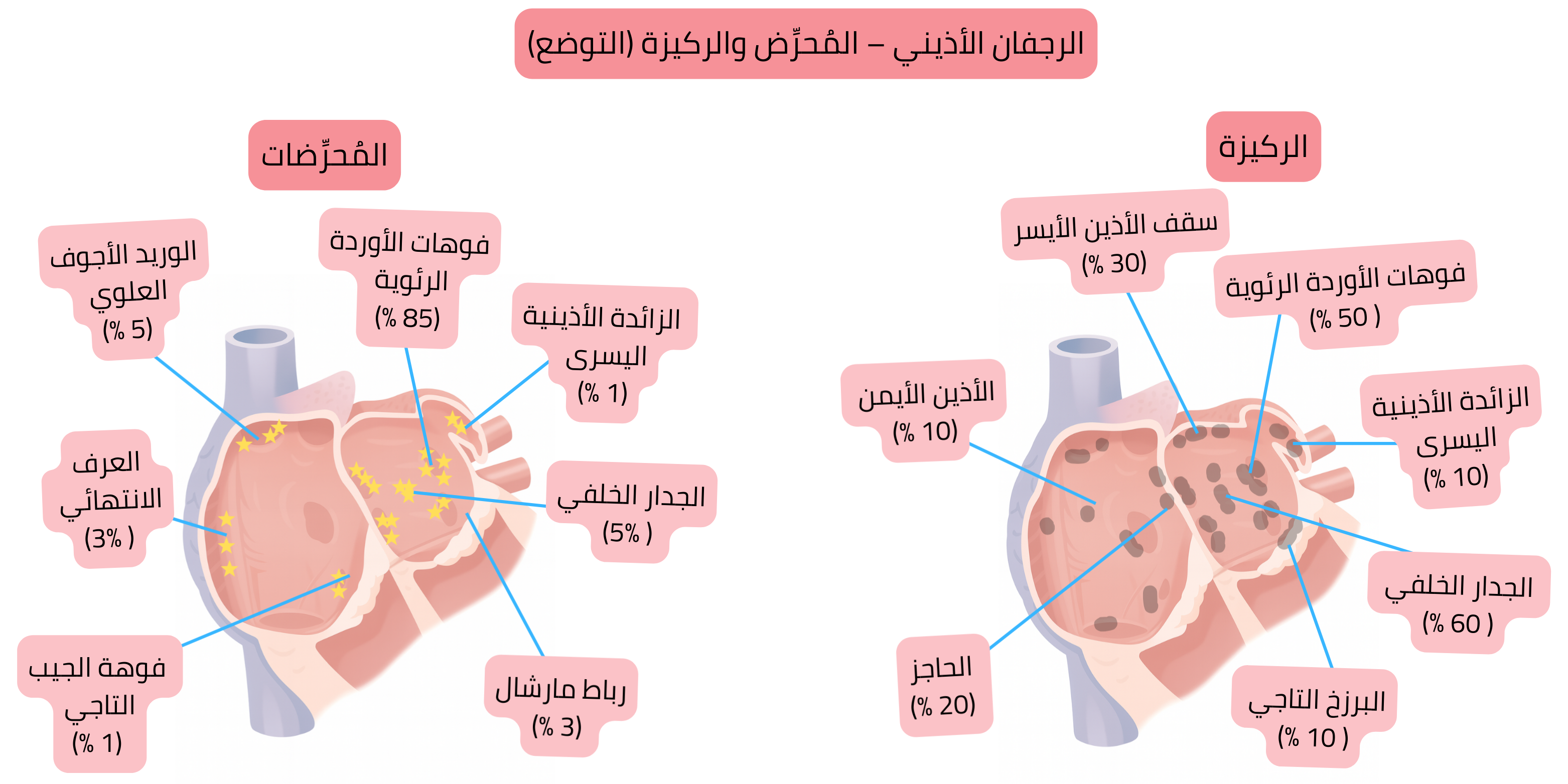 مخطط الرجفان الأذيني يوضح توضع البؤر المحفِّزة والركيزة المُسببة لاضطراب النظم في الأذينين الأيسر والأيمن، بما في ذلك فتحات الأوردة الرئوية، زائدة الأذين الأيسر والجدار الخلفي.