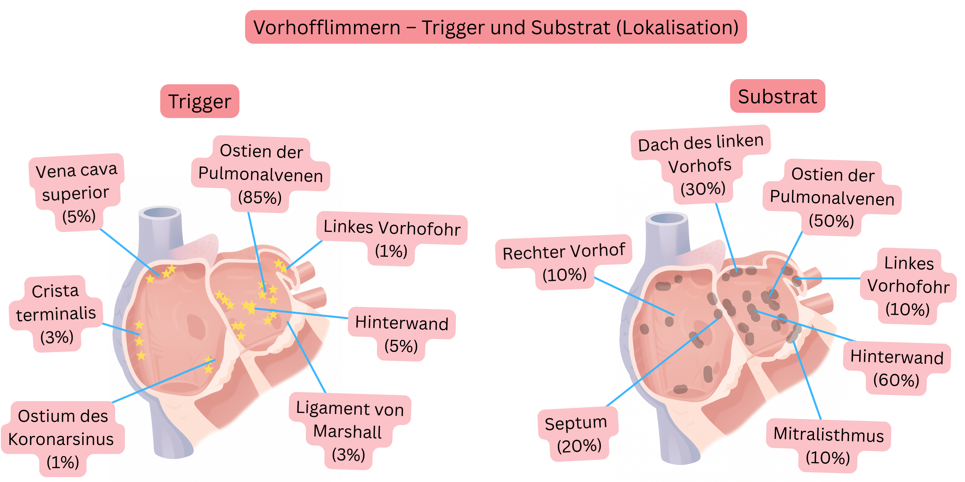 Schema des Vorhofflimmerns mit Darstellung der Lokalisation von Triggern und arrhythmogenem Substrat im linken und rechten Vorhof, einschließlich Pulmonalvenenostien, linkem Vorhofohr und posteriorer Wand.