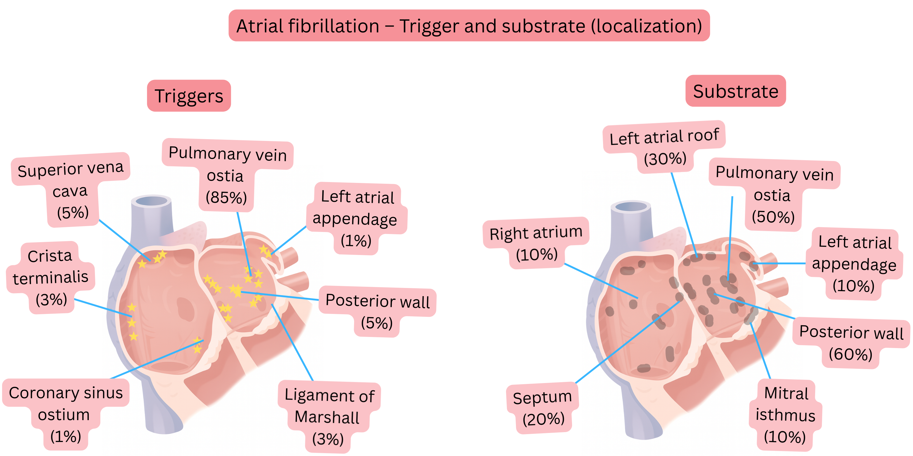 Diagram of atrial fibrillation illustrating the location of triggers and the arrhythmogenic substrate in the left and right atria, including pulmonary vein ostia, the left atrial appendage, and the posterior wall.