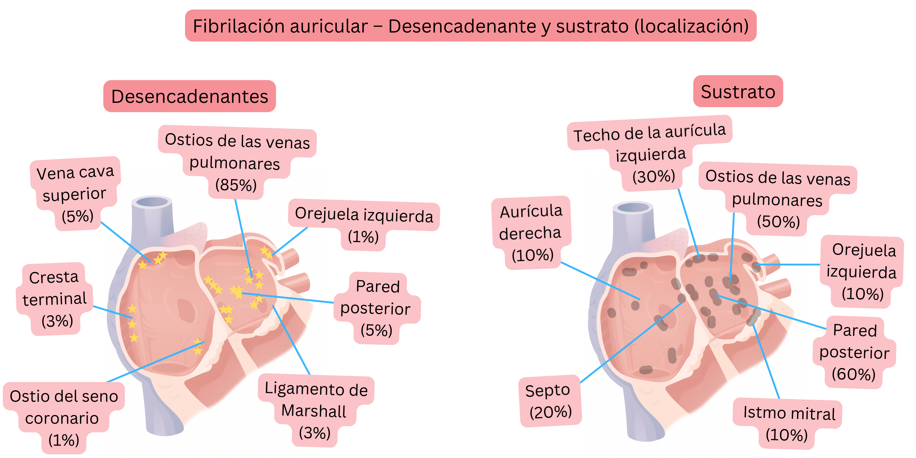 Esquema de la fibrilación auricular que muestra la localización de los desencadenantes y del sustrato arritmogénico en la aurícula izquierda y derecha, incluyendo los ostios de las venas pulmonares, la orejuela izquierda y la pared posterior.