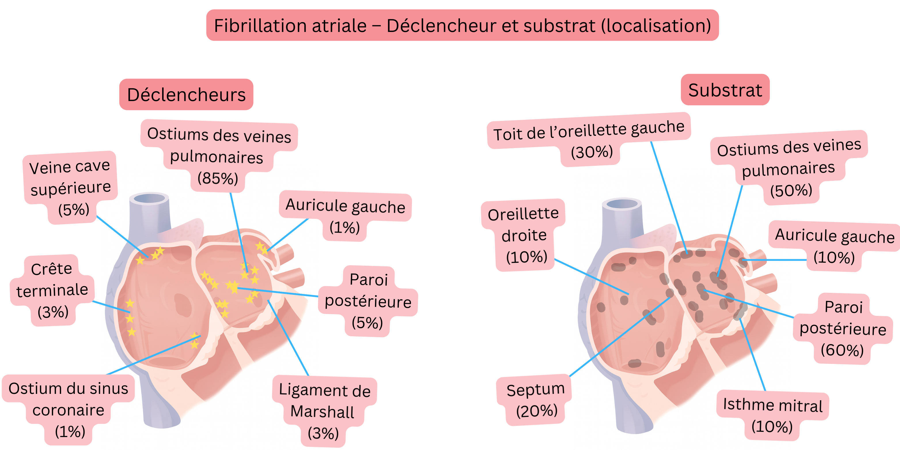 Schéma de la fibrillation auriculaire illustrant la localisation des déclencheurs et du substrat arythmogène dans les oreillettes gauche et droite, incluant les ostia des veines pulmonaires, l’appendice auriculaire gauche et la paroi postérieure.