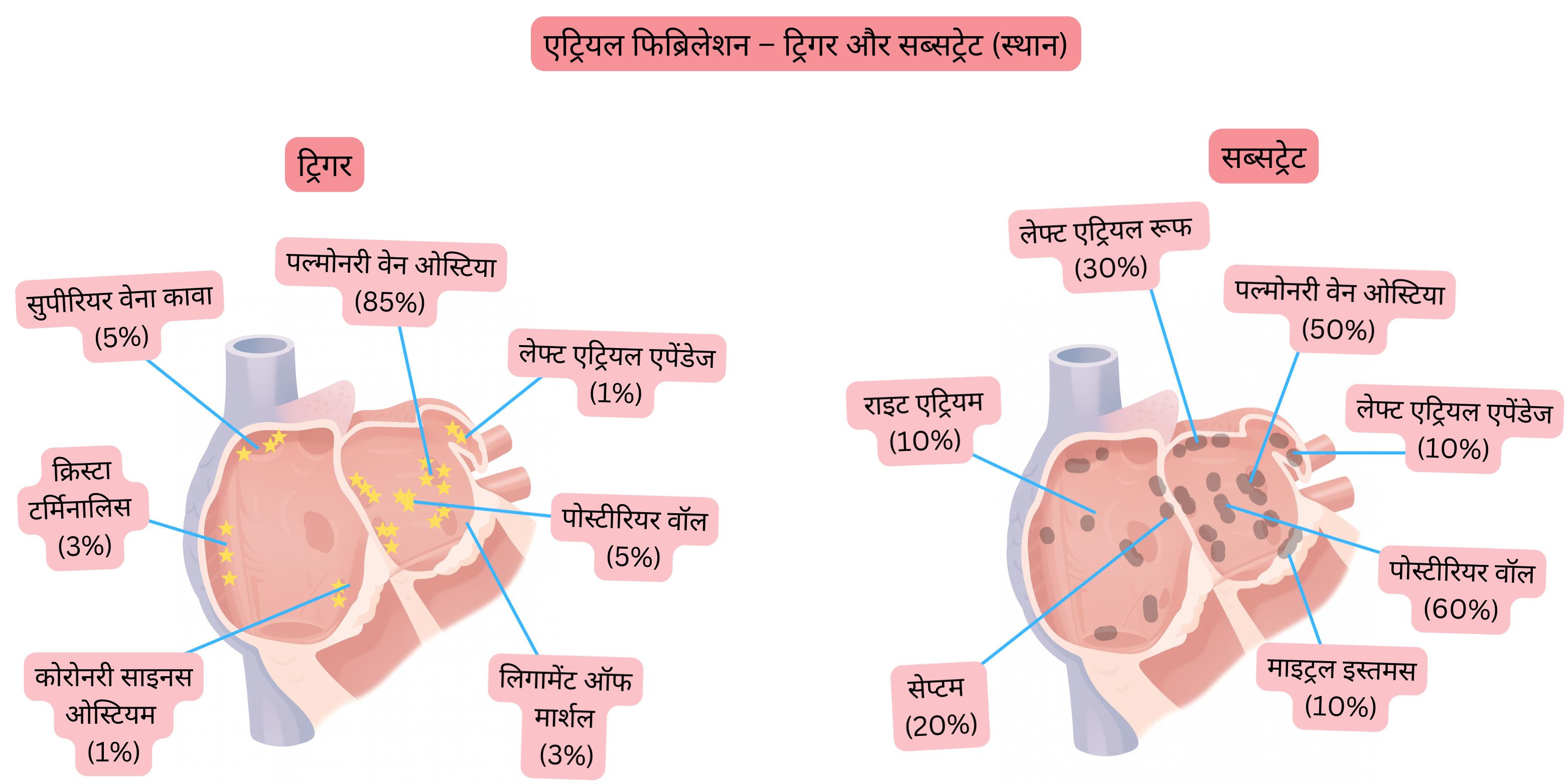 एट्रियल फिब्रिलेशन का आरेख, जिसमें बाएँ और दाएँ एट्रियम में ट्रिगर और एरिद्मोजेनिक सब्सट्रेट का स्थान दर्शाया गया है, जिसमें पल्मोनरी वेन ओस्टीआ, लेफ्ट एट्रियल एपेंडेज और पोस्टीरियर वॉल शामिल हैं।