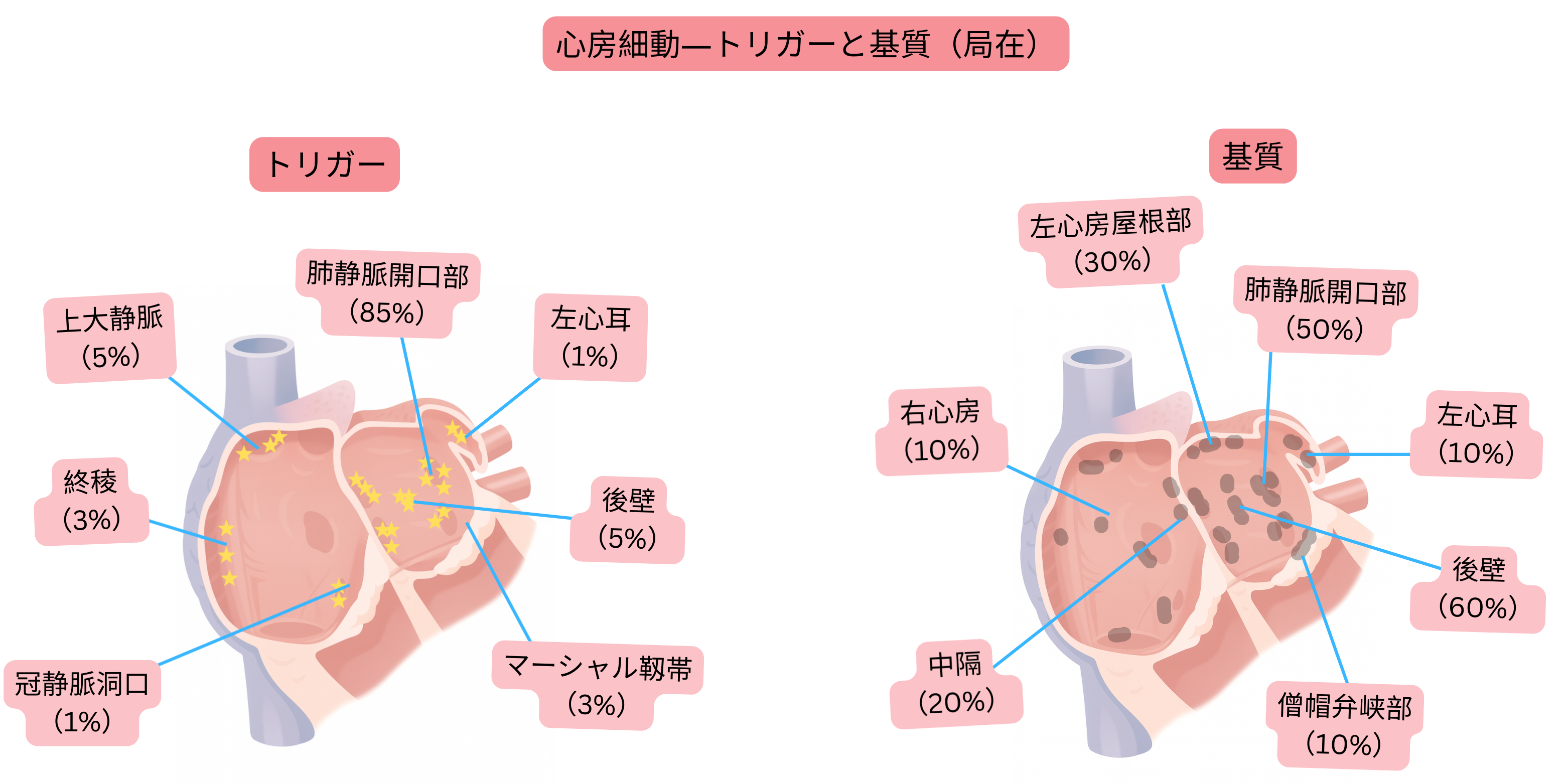心房細動の模式図で、肺静脈開口部、左心耳、後壁を含む左・右心房におけるトリガーおよび不整脈基質の局在を示す。