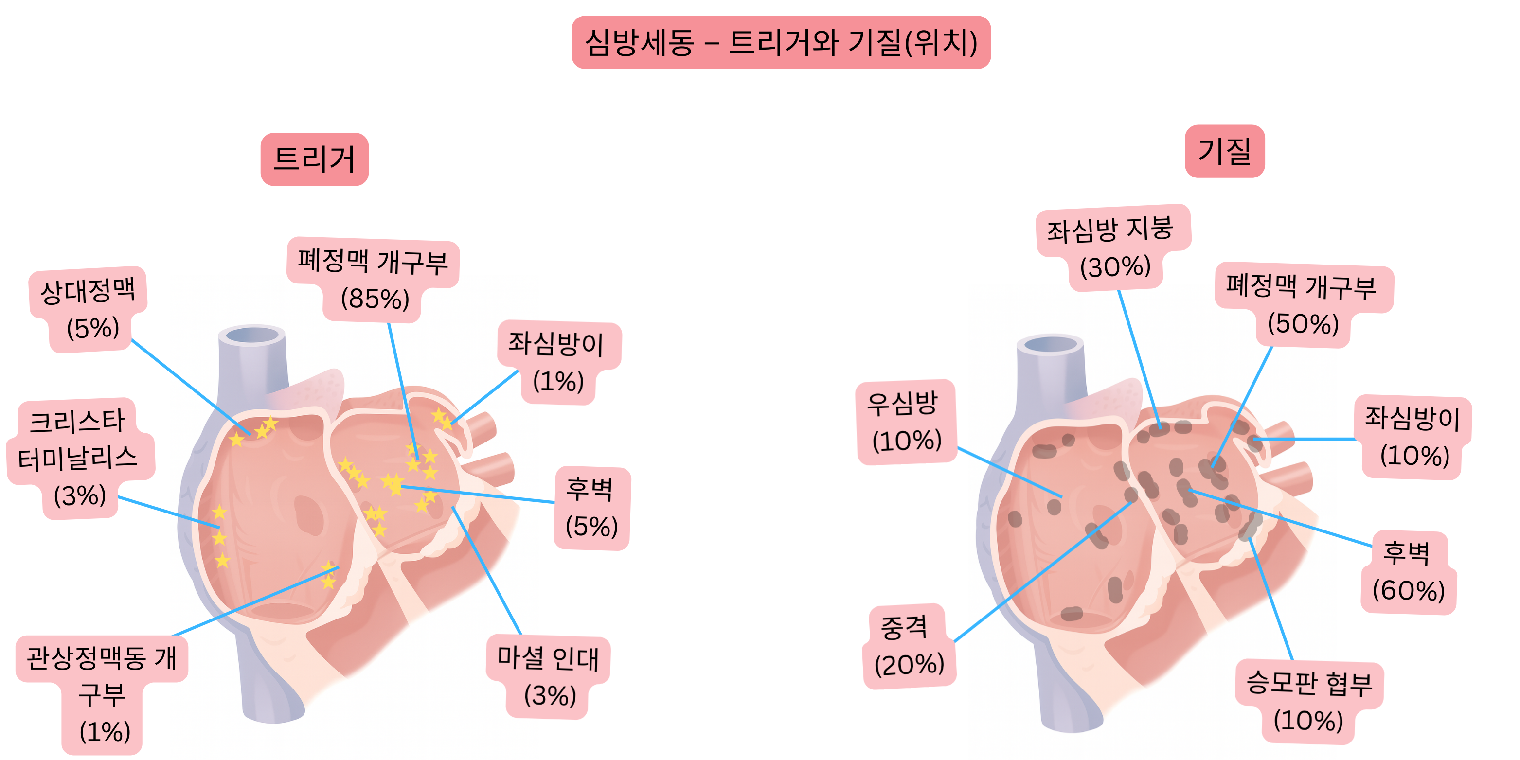 심방세동 도식으로, 폐정맥 개구부, 좌심방이 및 후벽을 포함한 좌·우심방 내 트리거와 부정맥 기질의 위치를 보여준다.