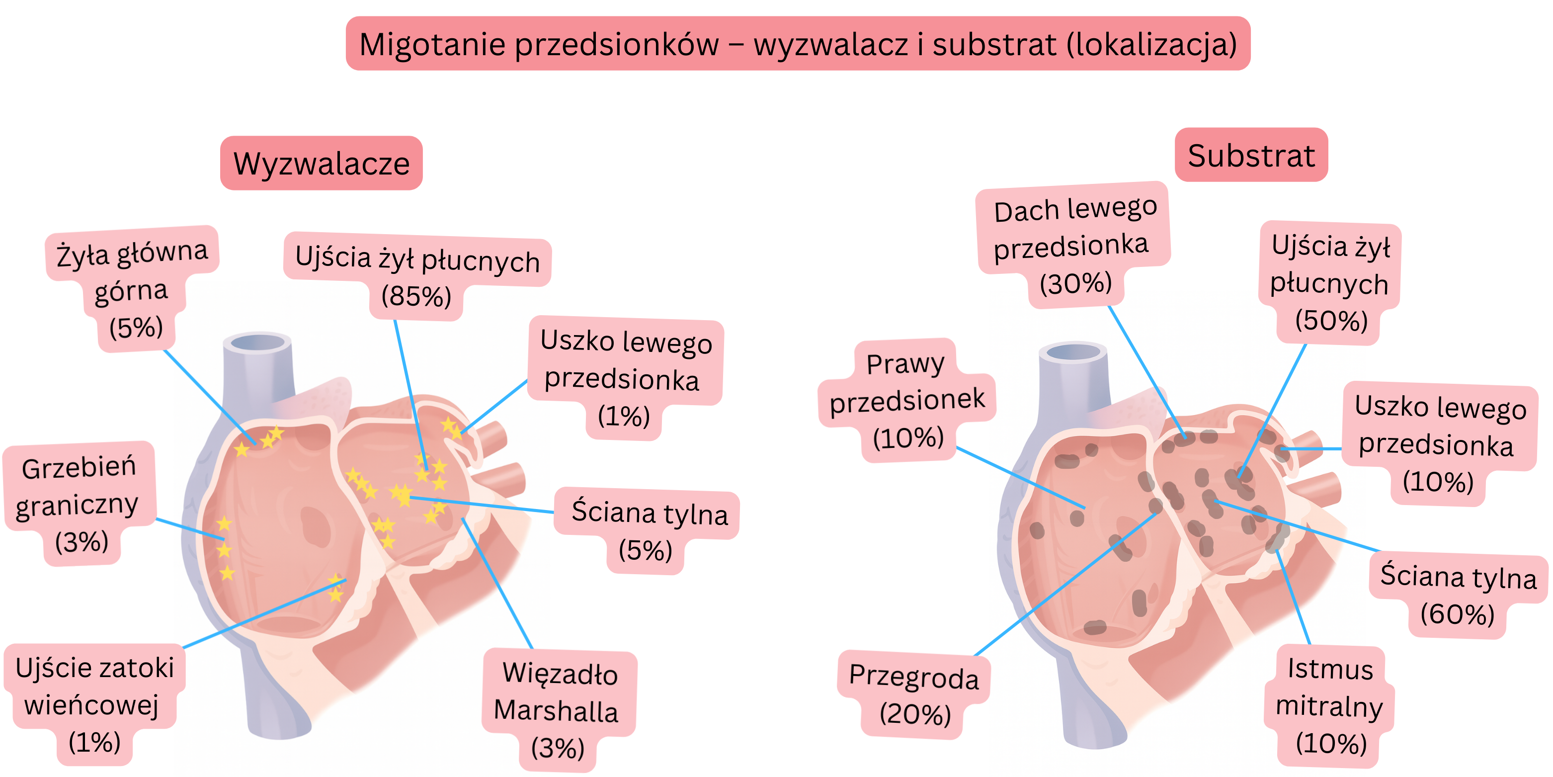 Schemat migotania przedsionków przedstawiający lokalizację wyzwalaczy i substratu arytmogennego w lewym i prawym przedsionku, w tym ujścia żył płucnych, uszko lewego przedsionka oraz ścianę tylną.