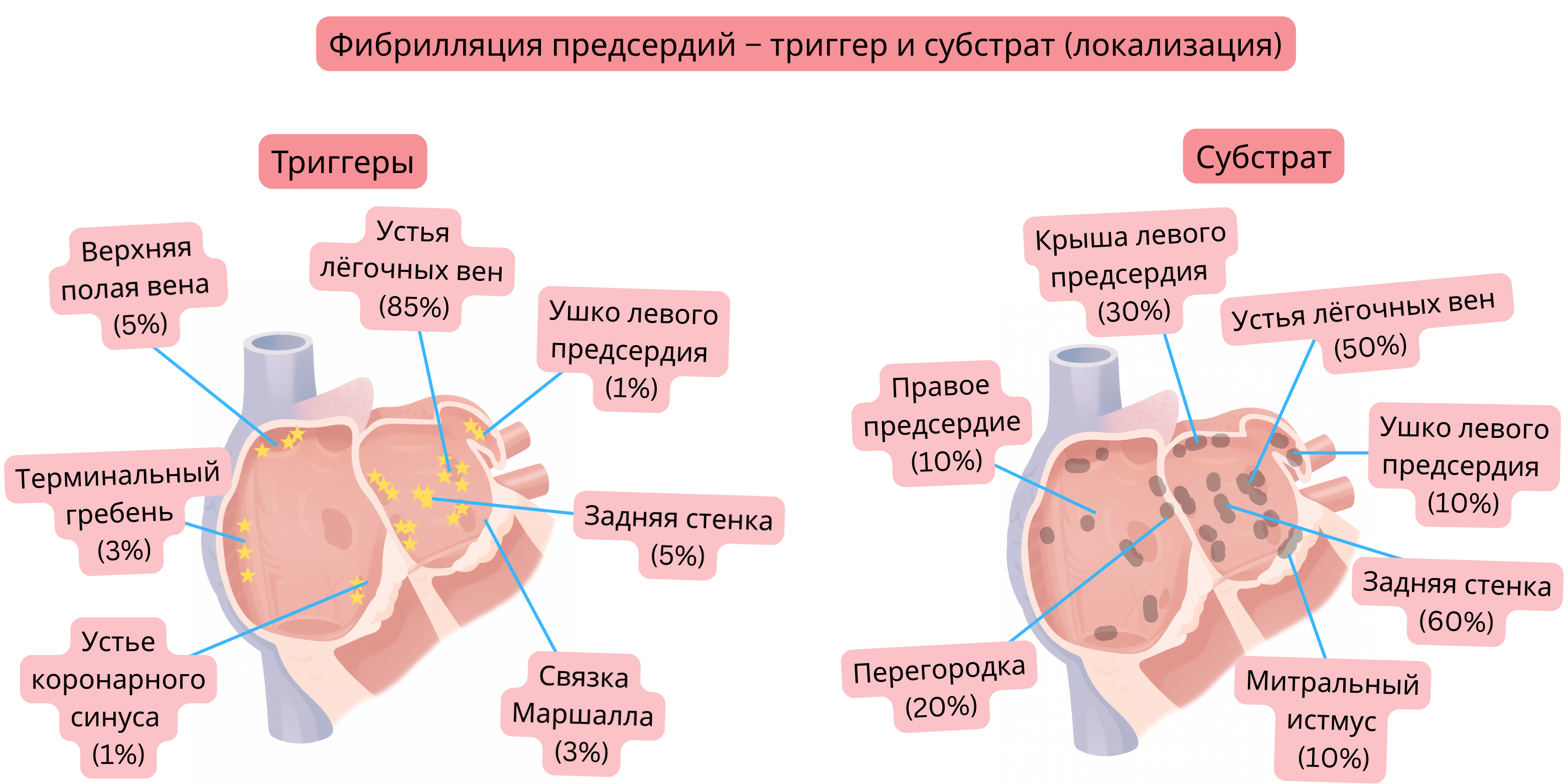 Схема фибрилляции предсердий, демонстрирующая локализацию триггеров и аритмогенного субстрата в левом и правом предсердиях, включая устья лёгочных вен, ушко левого предсердия и заднюю стенку.
