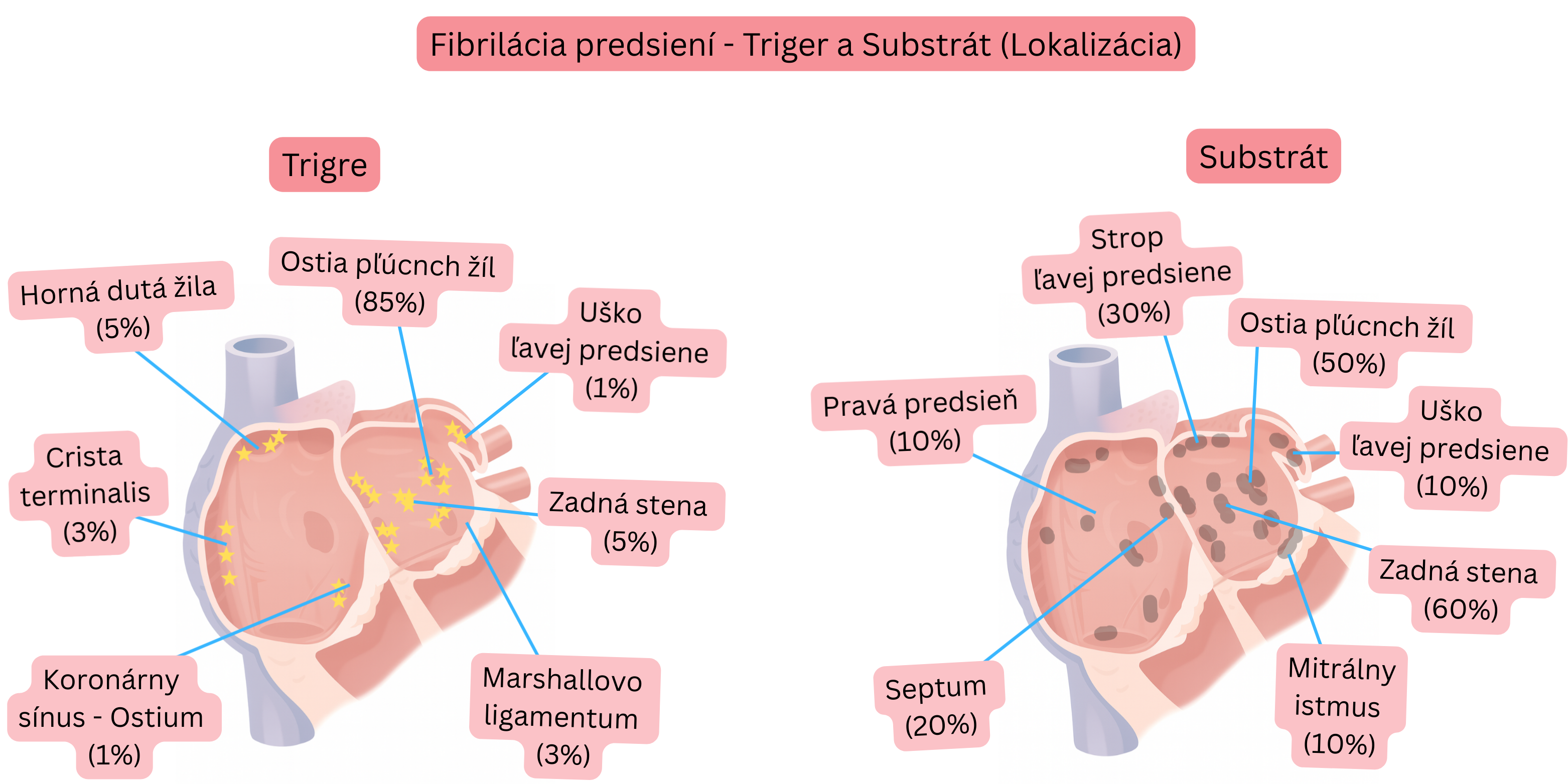 Schéma fibrilácie predsiení znázorňujúca lokalizáciu spúšťačov a arytmogénneho substrátu v ľavej a pravej predsieni vrátane ostií pľúcnych žíl, uška ľavej predsiene a zadnej steny.