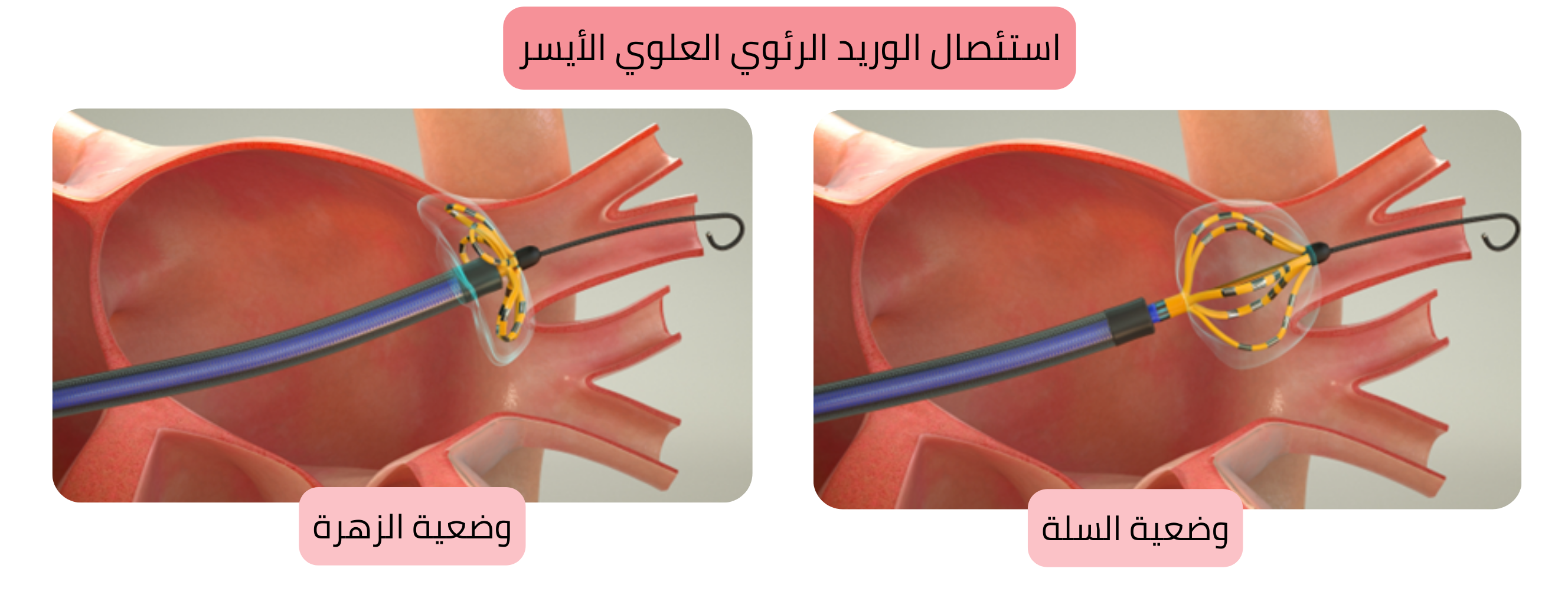 مخطط استئصال الرجفان الأذيني يوضح عزل الوريد الرئوي العلوي الأيسر مع وضع قسطرة الاستئصال في وضعيّة السلة والزهرة.