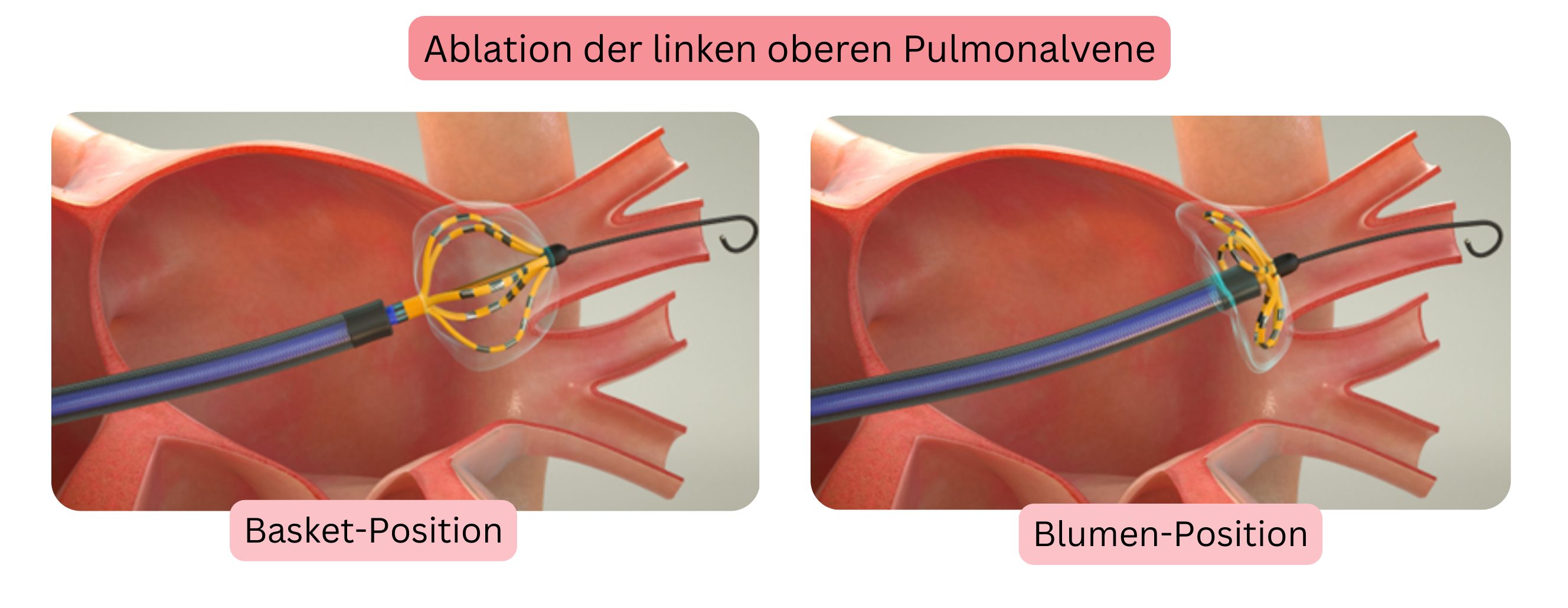 Schema der Ablation von Vorhofflimmern mit Darstellung der Isolation der linken oberen Pulmonalvene und Positionierung des Ablationskatheters in Korb- und Blumenposition.