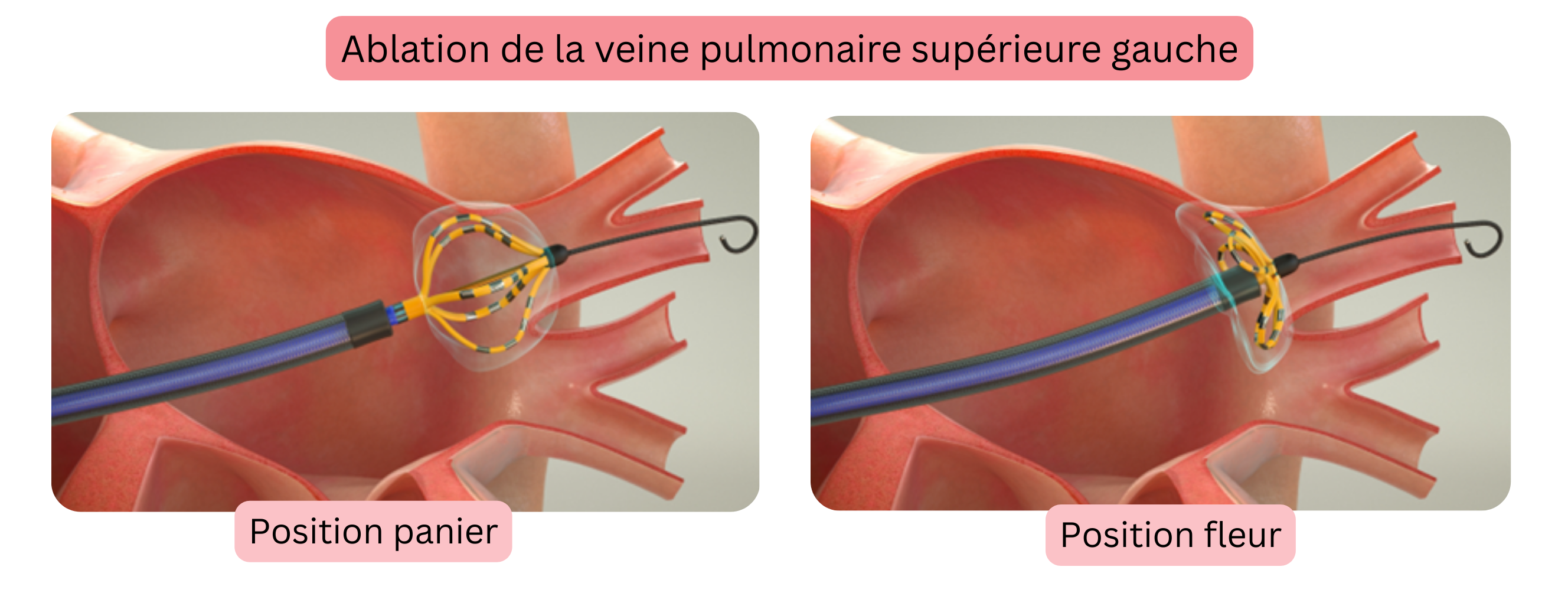 Schéma de l’ablation de la fibrillation auriculaire illustrant l’isolement de la veine pulmonaire supérieure gauche avec positionnement du cathéter d’ablation en configuration panier et fleur.