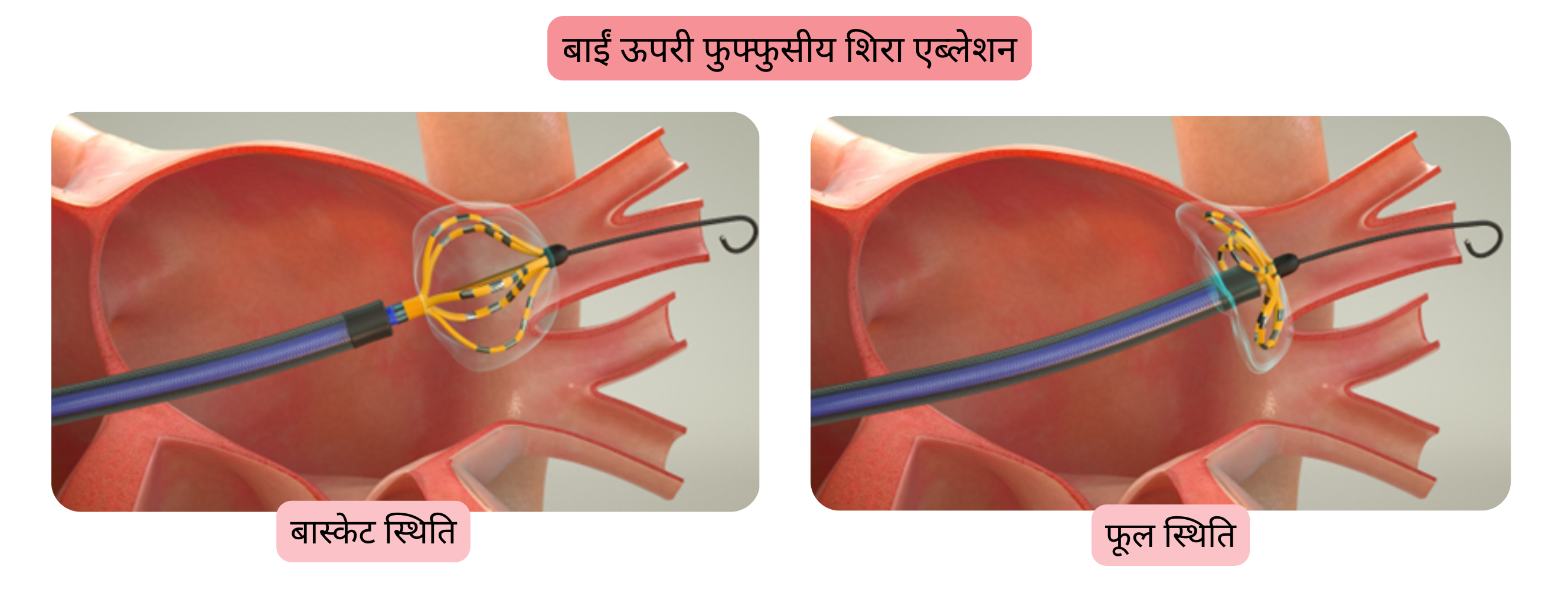 एट्रियल फिब्रिलेशन एब्लेशन का आरेख, जिसमें बाएँ ऊपरी पल्मोनरी वेन के आइसोलेशन और एब्लेशन कैथेटर को बास्केट तथा फ्लावर कॉन्फ़िगरेशन में दर्शाया गया है।