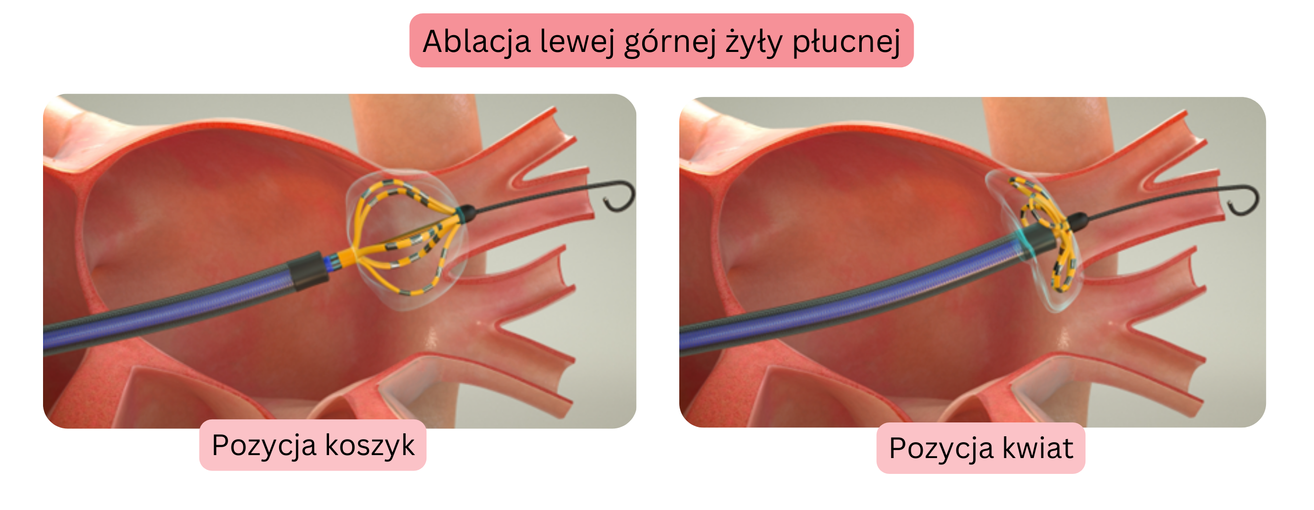Schemat ablacji migotania przedsionków przedstawiający izolację lewej górnej żyły płucnej z umieszczeniem cewnika ablacyjnego w pozycji koszykowej i kwiatowej.
