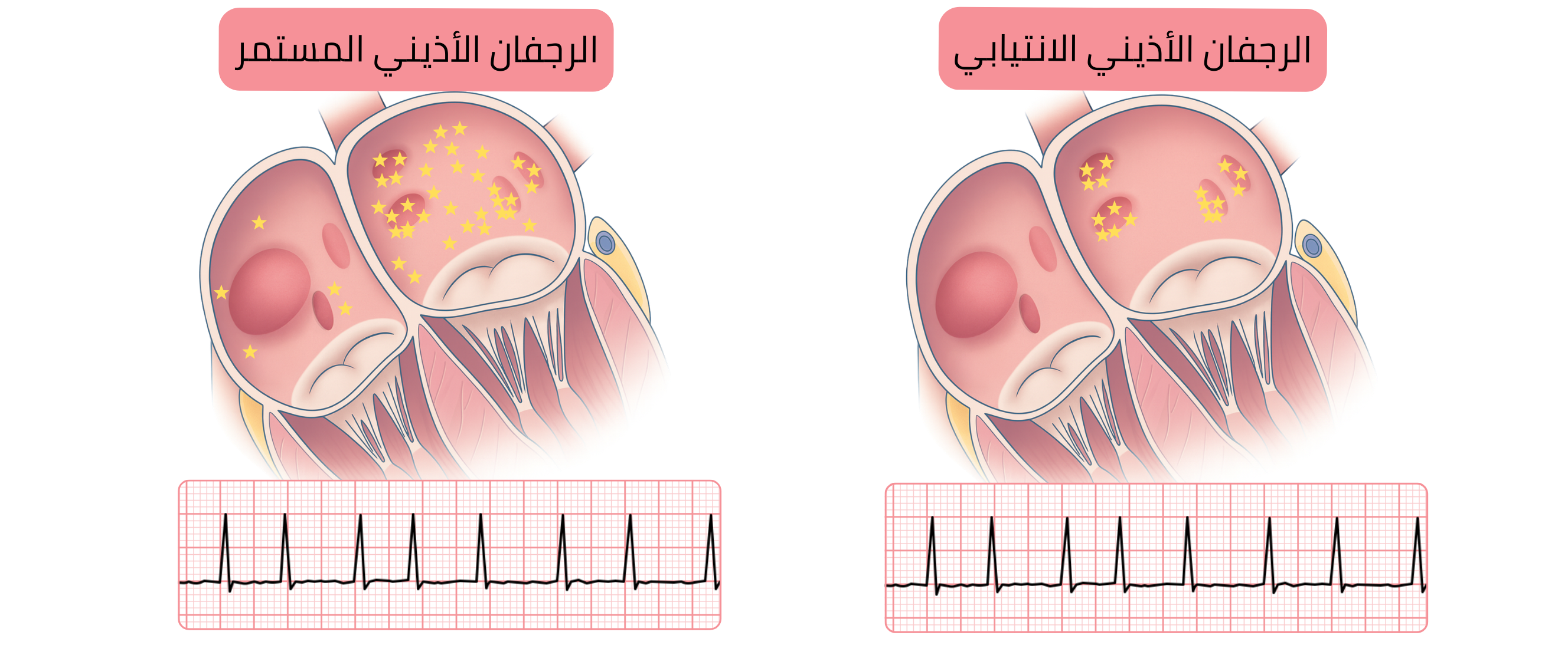 مخطط يقارن بين الرجفان الأذيني الانتيابي والمستمر موضحًا اختلاف توزع البؤر المُسببة لاضطراب النظم في عضلة الأذينين والتظاهرات المقابلة على تخطيط القلب.