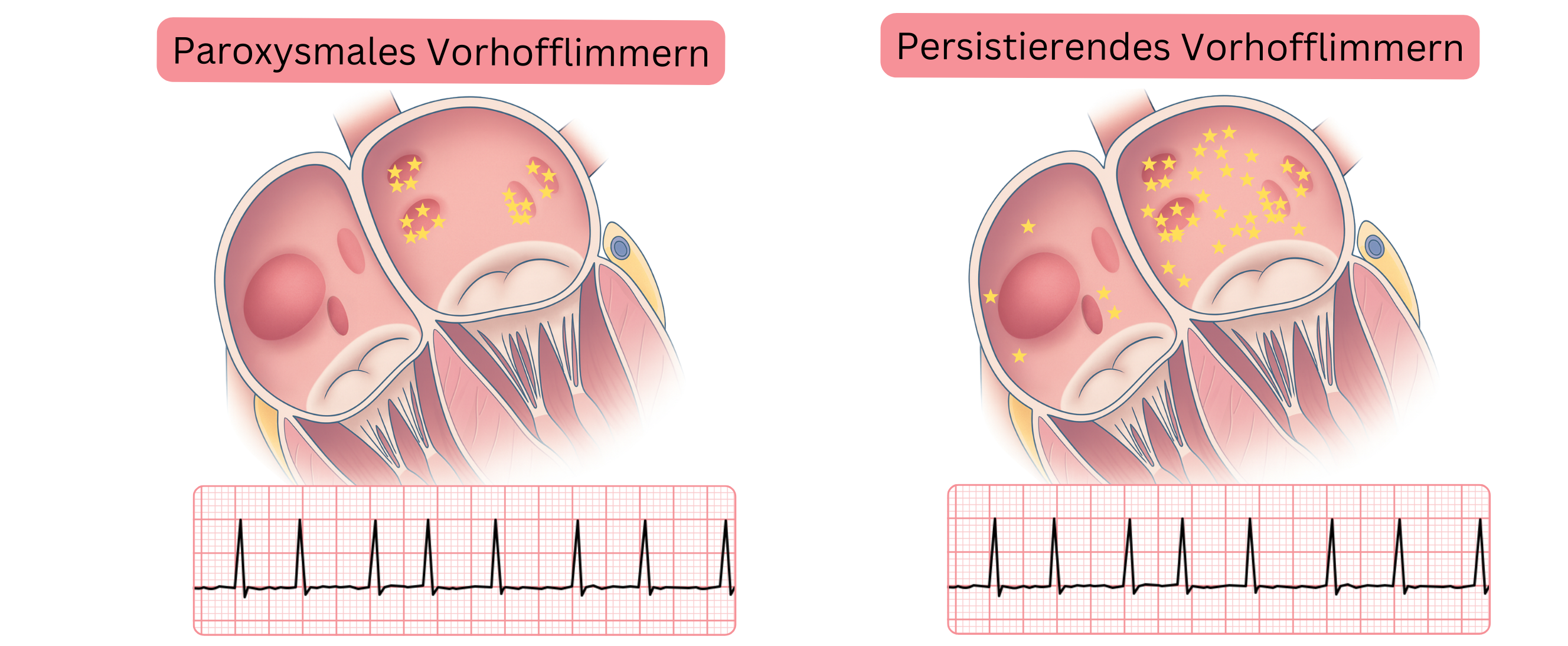 Schema zum Vergleich von paroxysmalem und persistierendem Vorhofflimmern mit Darstellung der unterschiedlichen Verteilung arrhythmogener Herde im Vorhofmyokard und der entsprechenden EKG-Befunde.