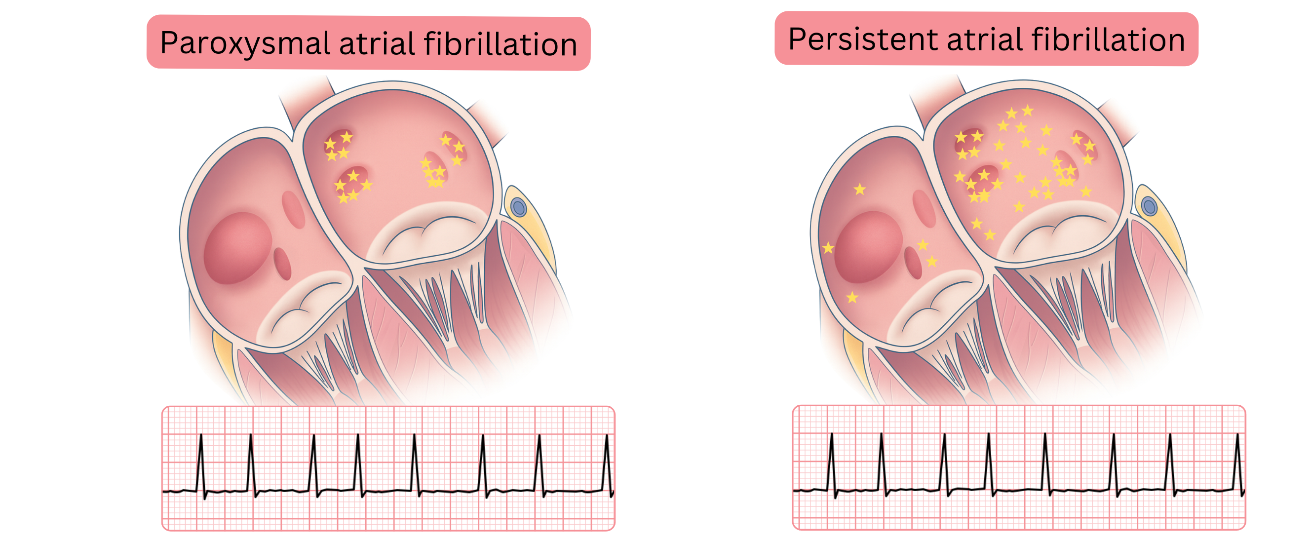 Diagram comparing paroxysmal and persistent atrial fibrillation illustrating differences in the distribution of arrhythmogenic foci within the atrial myocardium and corresponding ECG manifestations.