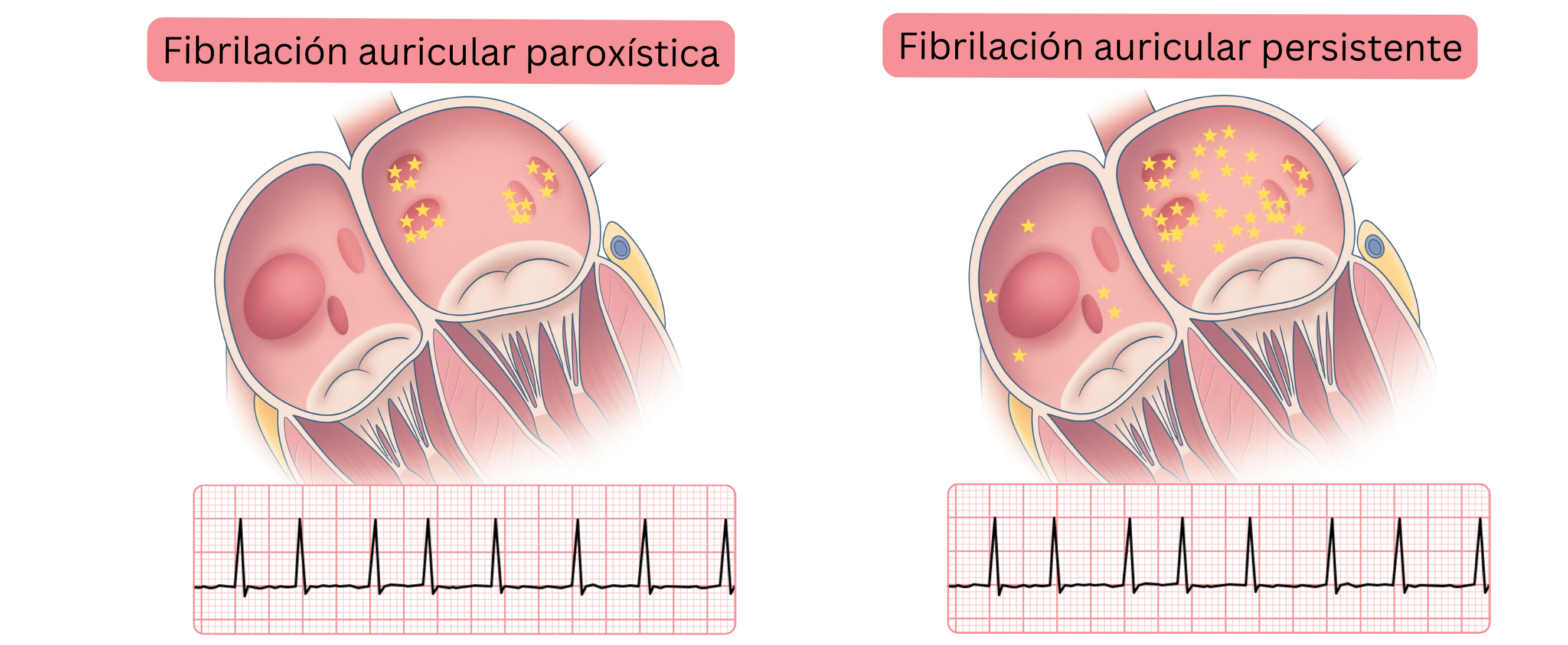 Esquema que compara la fibrilación auricular paroxística y persistente, mostrando las diferencias en la distribución de los focos arritmogénicos en el miocardio auricular y las manifestaciones correspondientes en el ECG.
