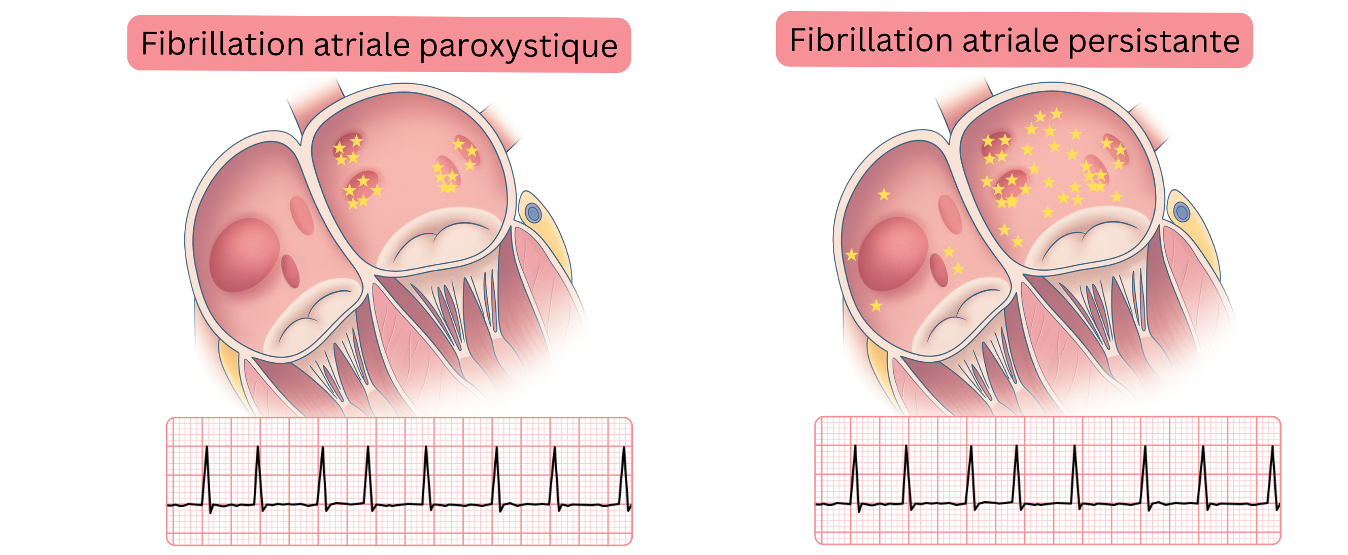 Schéma comparant la fibrillation auriculaire paroxystique et persistante, illustrant les différences de distribution des foyers arythmogènes dans le myocarde auriculaire et les manifestations ECG correspondantes.