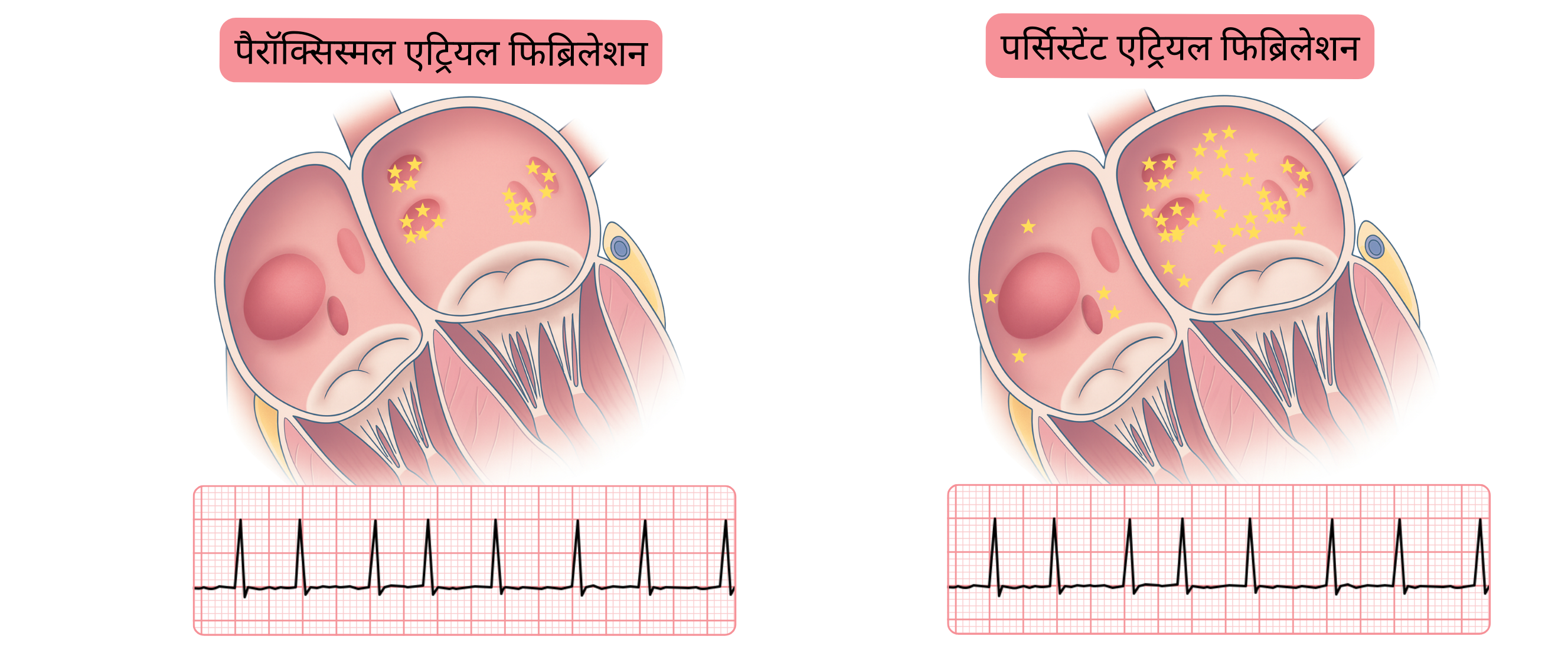 पैरॉक्सिस्मल और पर्सिस्टेंट एट्रियल फिब्रिलेशन की तुलना करने वाला आरेख, जिसमें एट्रियल मायोकार्डियम में एरिद्मोजेनिक फोकस के वितरण में अंतर और संबंधित ईसीजी अभिव्यक्तियाँ दर्शाई गई हैं।