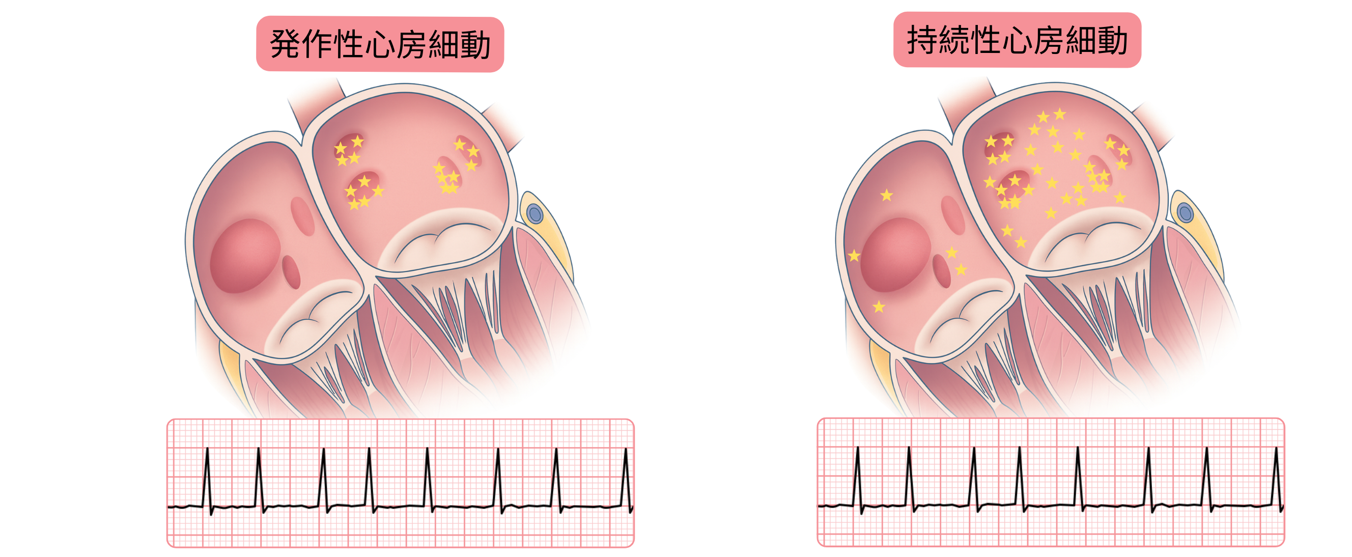 発作性および持続性心房細動を比較し、心房心筋における不整脈起源の分布差と対応する心電図所見を示す模式図。