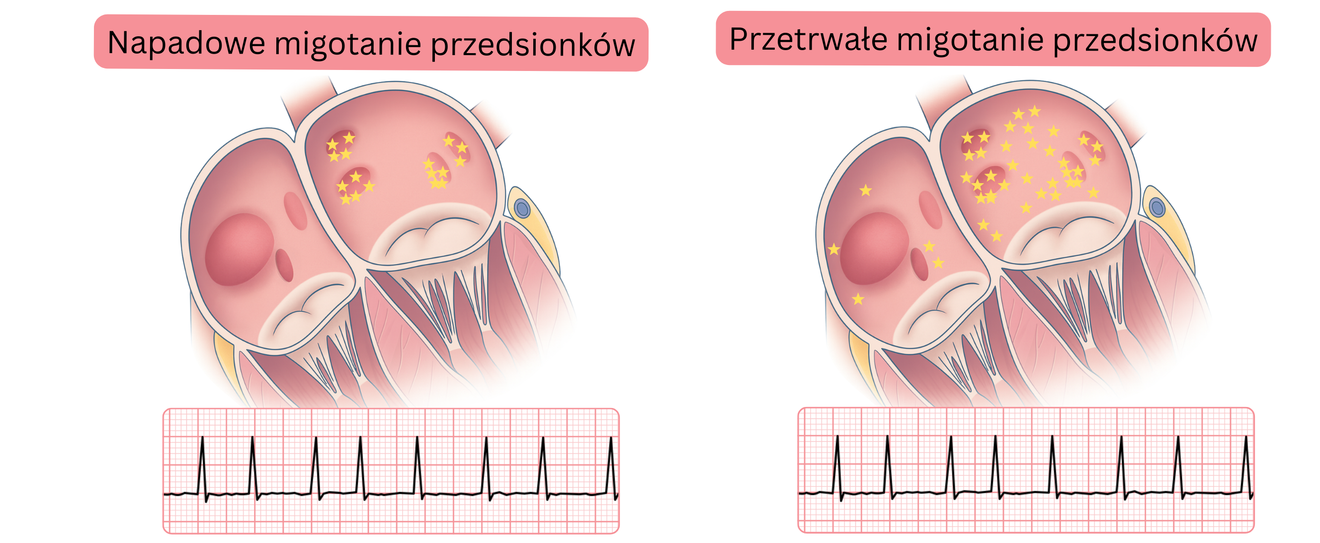 Schemat porównujący napadowe i przetrwałe migotanie przedsionków, przedstawiający różnice w rozmieszczeniu ognisk arytmogennych w mięśniu przedsionków oraz odpowiadające im cechy w zapisie EKG.
