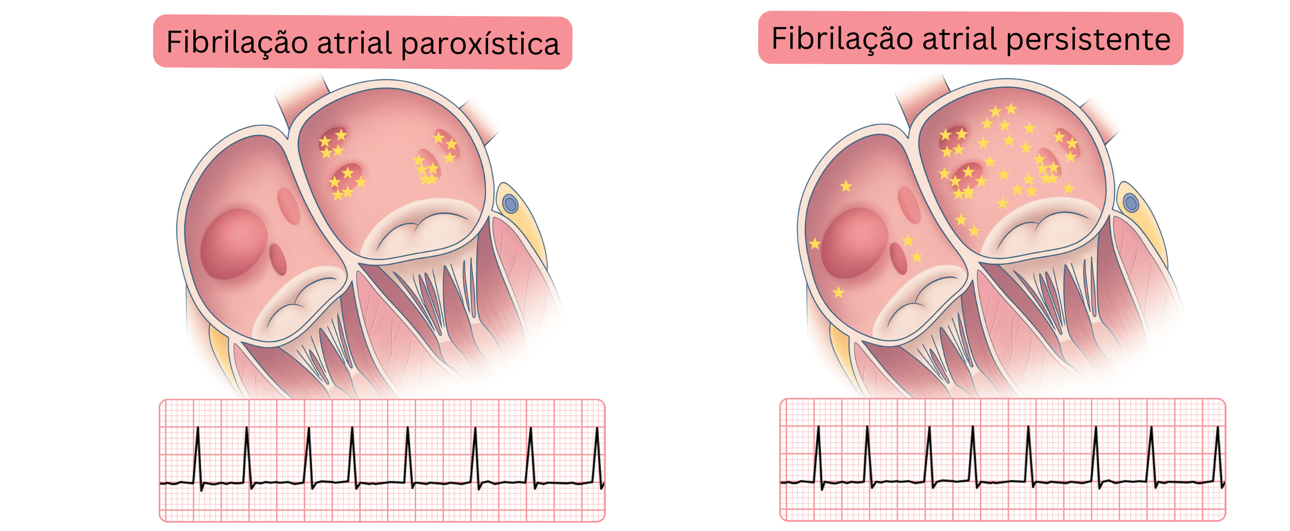 Esquema comparando a fibrilação atrial paroxística e persistente, demonstrando diferenças na distribuição dos focos arritmogénicos no miocárdio atrial e nas manifestações correspondentes no ECG.