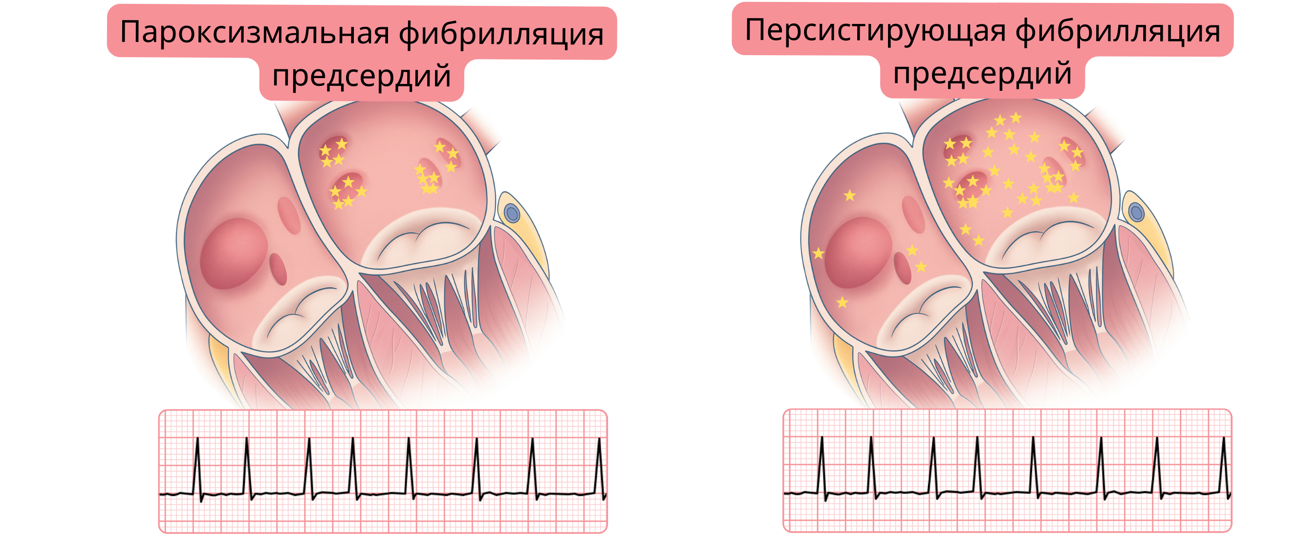Схема, сравнивающая пароксизмальную и персистирующую фибрилляцию предсердий, демонстрирующая различия в распределении аритмогенных очагов в миокарде предсердий и соответствующие изменения на ЭКГ.