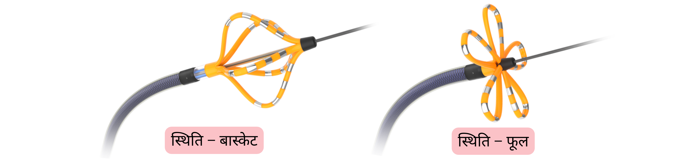 एट्रियल फिब्रिलेशन एब्लेशन के दौरान एब्लेशन कैथेटर का आरेख, जिसमें पल्मोनरी वेन आइसोलेशन के लिए प्रयुक्त बास्केट और फ्लावर कैथेटर पोज़िशन दर्शाई गई हैं।