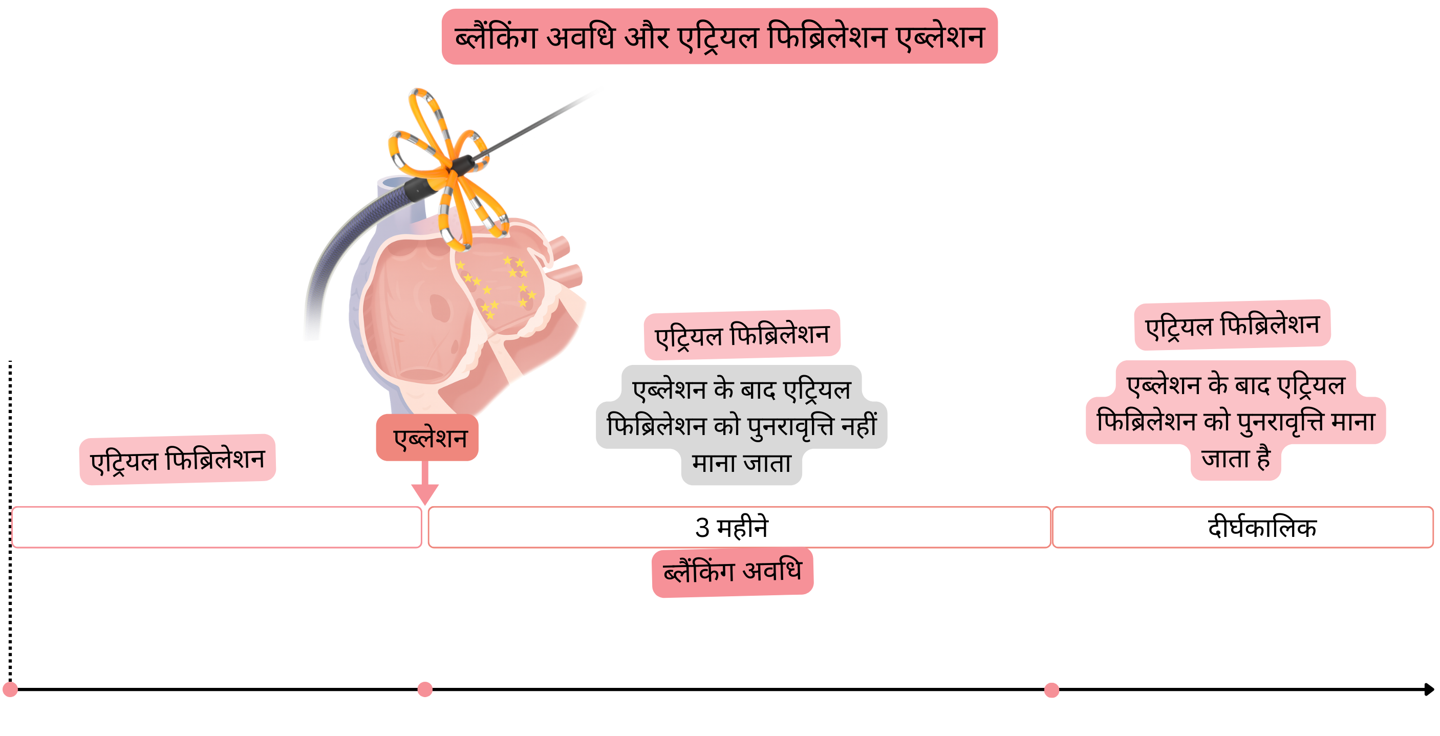 एट्रियल फिब्रिलेशन की कैथेटर एब्लेशन के बाद ब्लैंकिंग पीरियड का आरेख, जिसमें पहले तीन महीनों के दौरान एंटीएरिदमिक और एंटीकोआगुलेशन रणनीतियाँ तथा एट्रियल फिब्रिलेशन की पुनरावृत्ति और CHA₂DS₂-VASc स्कोर के आधार पर दीर्घकालिक प्रबंधन दर्शाया गया है।