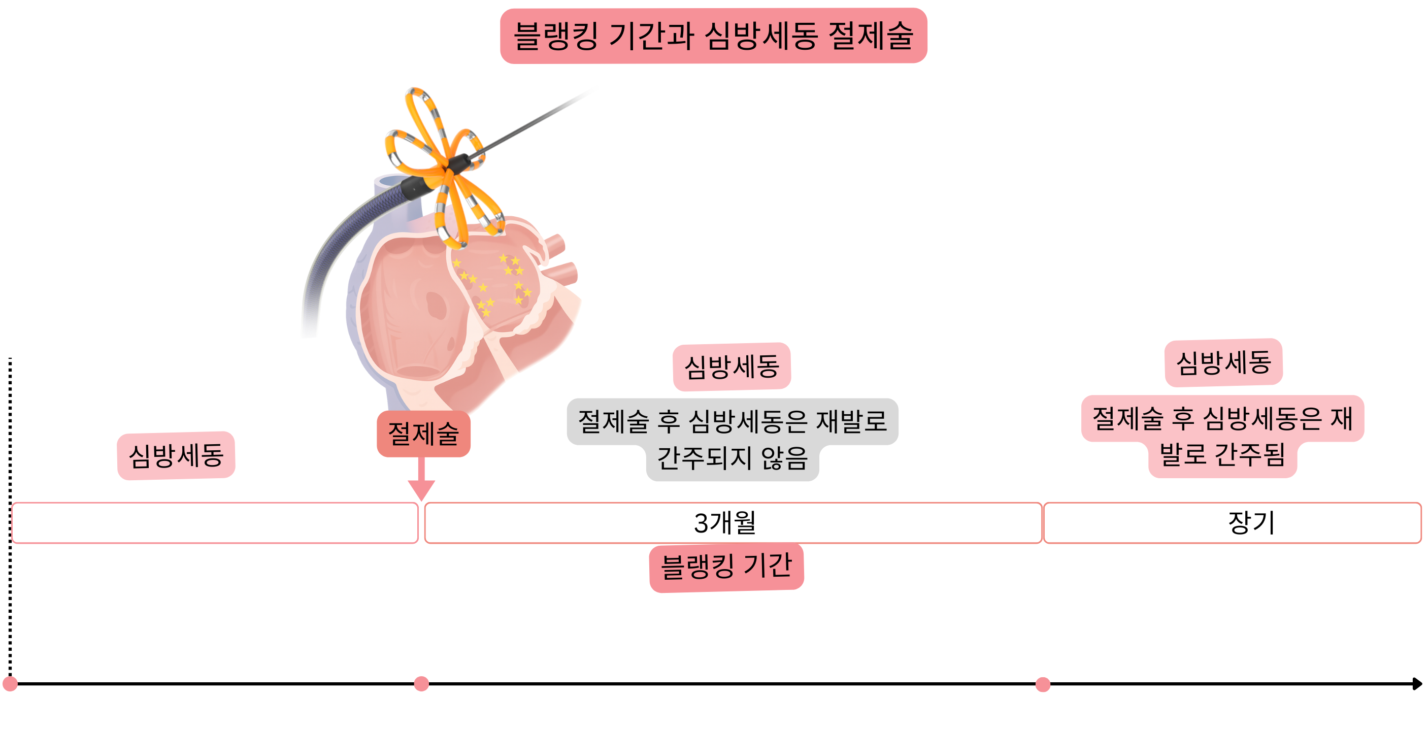 심방세동 카테터 절제술 후 블랭킹 기간을 나타낸 도식으로, 초기 3개월간의 항부정맥 및 항응고 치료 전략과 심방세동 재발 여부 및 CHA₂DS₂-VASc 점수에 따른 장기 관리 방침을 보여준다.