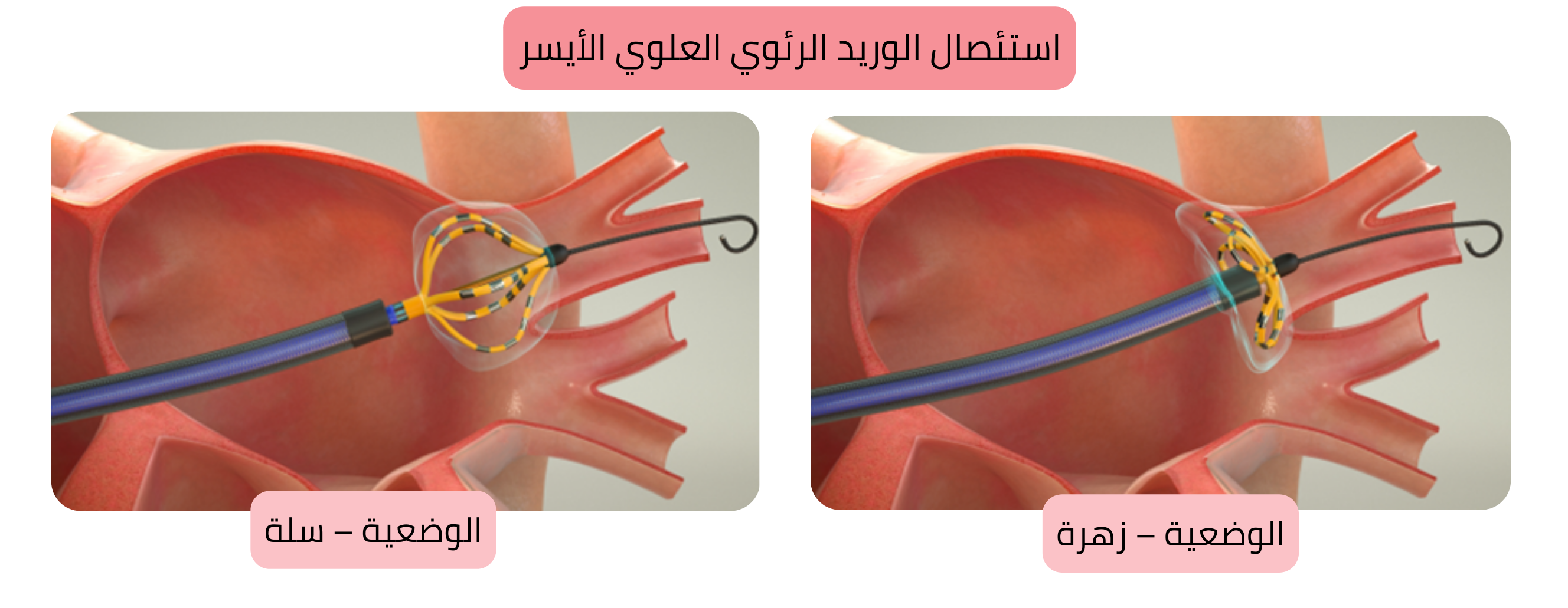 مخطط الاستئصال بالقسطرة للرجفان الأذيني يوضح عزل الوريد الرئوي العلوي الأيسر مع وضع قسطرة الاستئصال في وضعيتي السلة والزهرة.