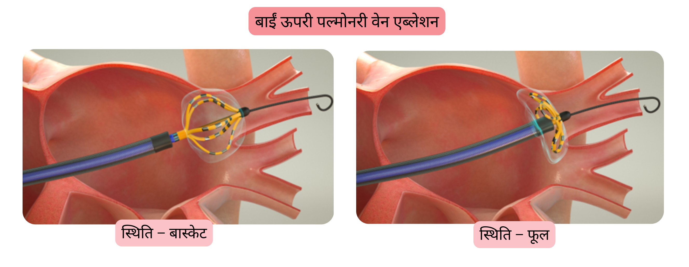 एट्रियल फिब्रिलेशन की कैथेटर एब्लेशन का आरेख, जिसमें बाईं ऊपरी पल्मोनरी वेन का आइसोलेशन तथा एब्लेशन कैथेटर को बास्केट और फ्लावर पोज़िशन में दर्शाया गया है।
